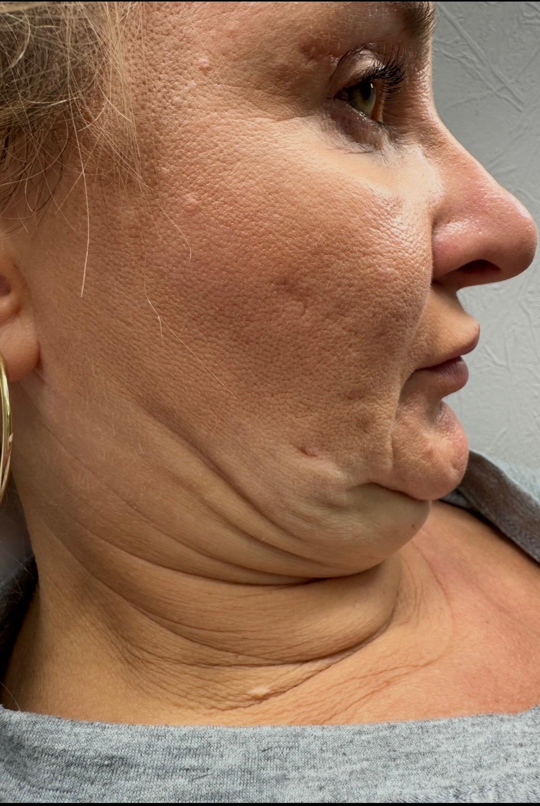 Owal twarzy przed lipolizą iniekcyjną — widoczna tkanka tłuszczowa pod brodą