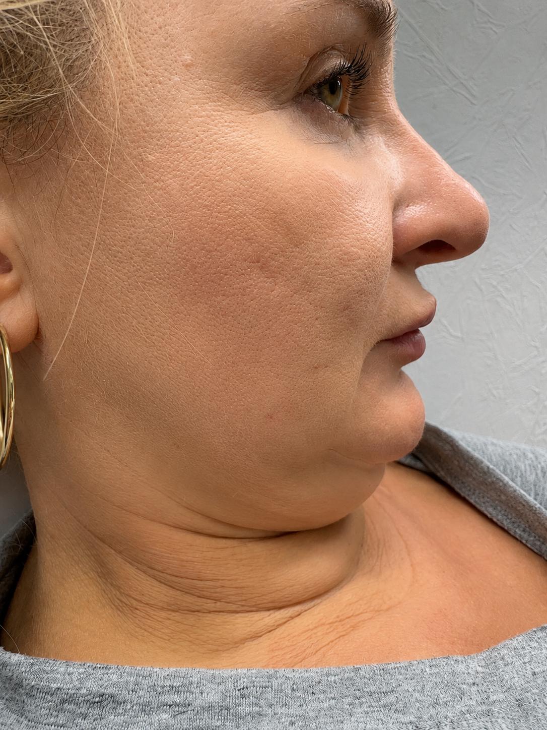 Owal twarzy po lipolizie iniekcyjnej — smuklejsza linia żuchwy i podbródka