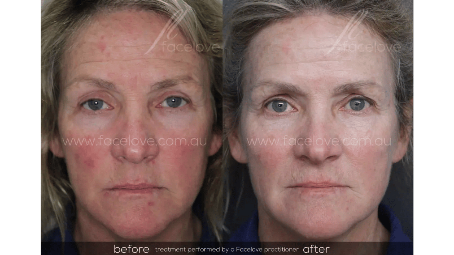 FaceLove patient result 1