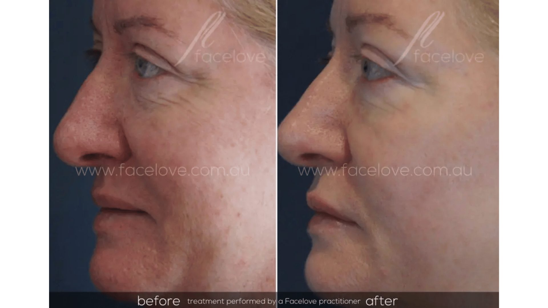 FaceLove patient result 3