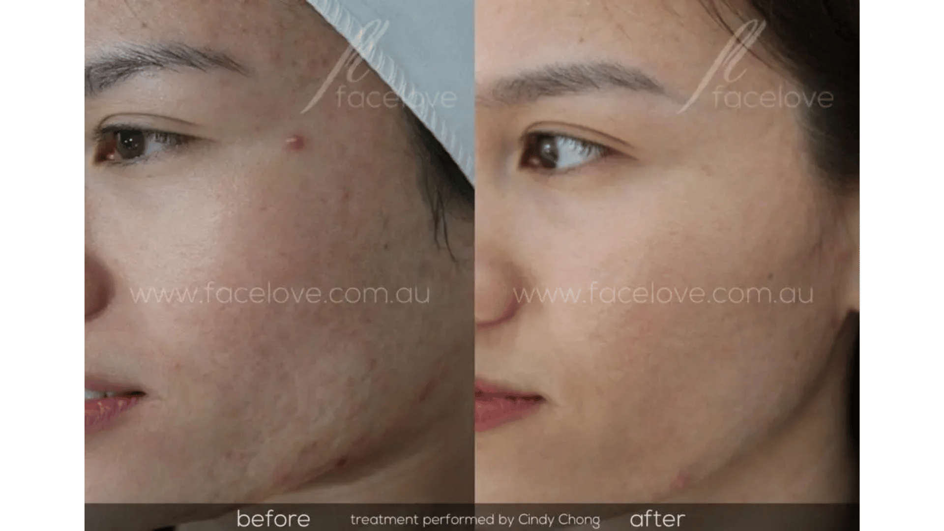 FaceLove patient result 2