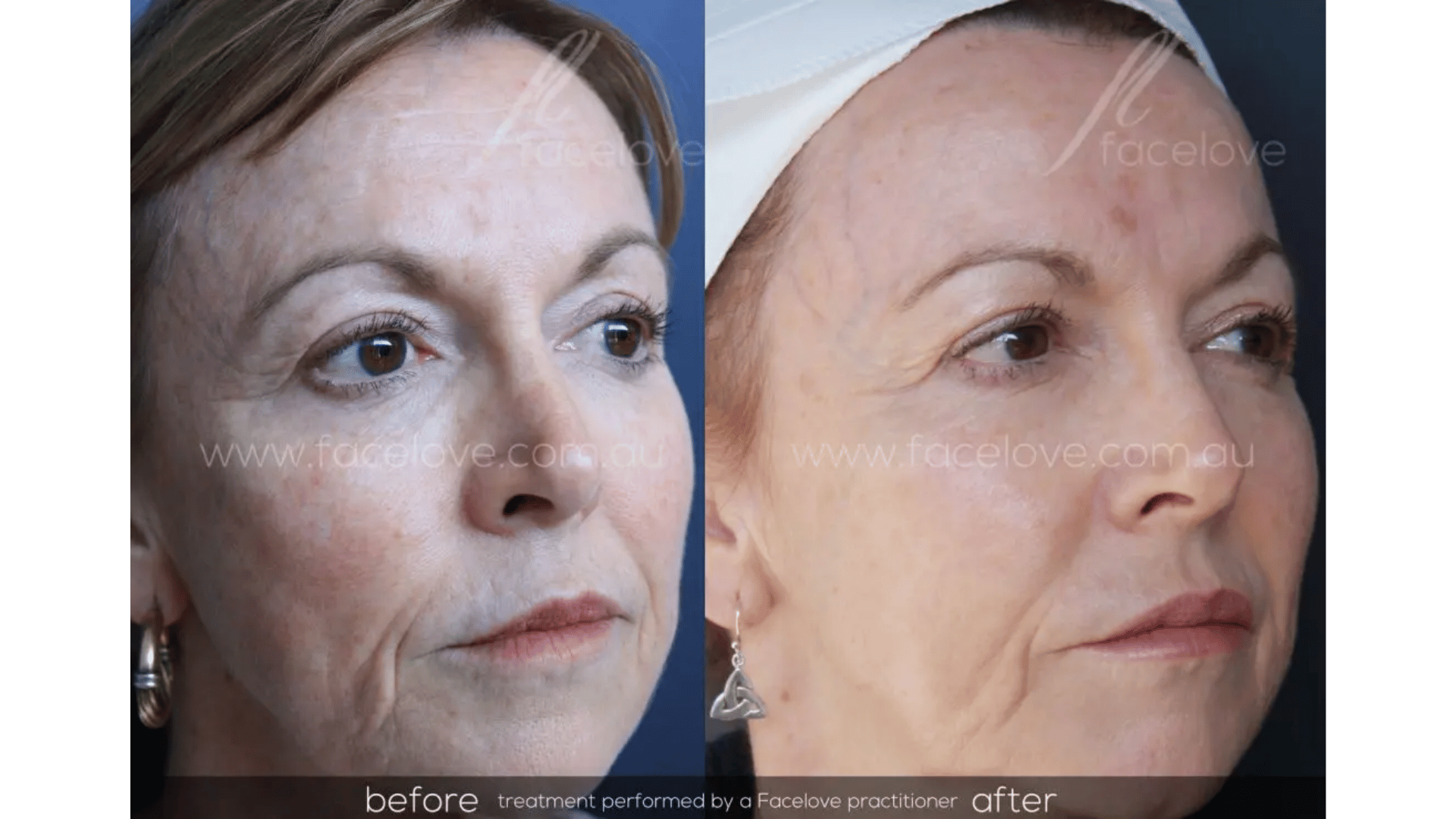 FaceLove patient result 5