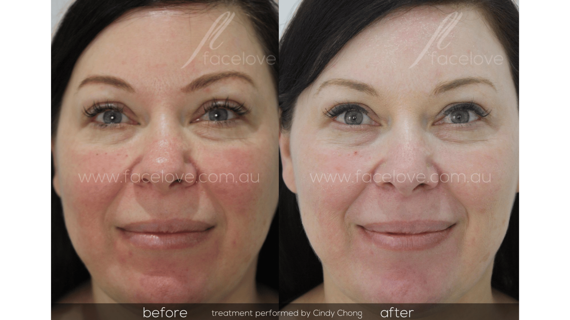 FaceLove patient result 4