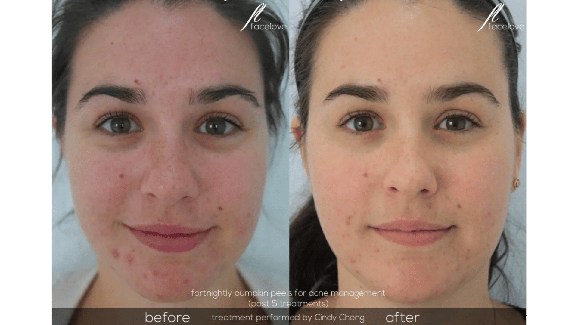 FaceLove patient result 6