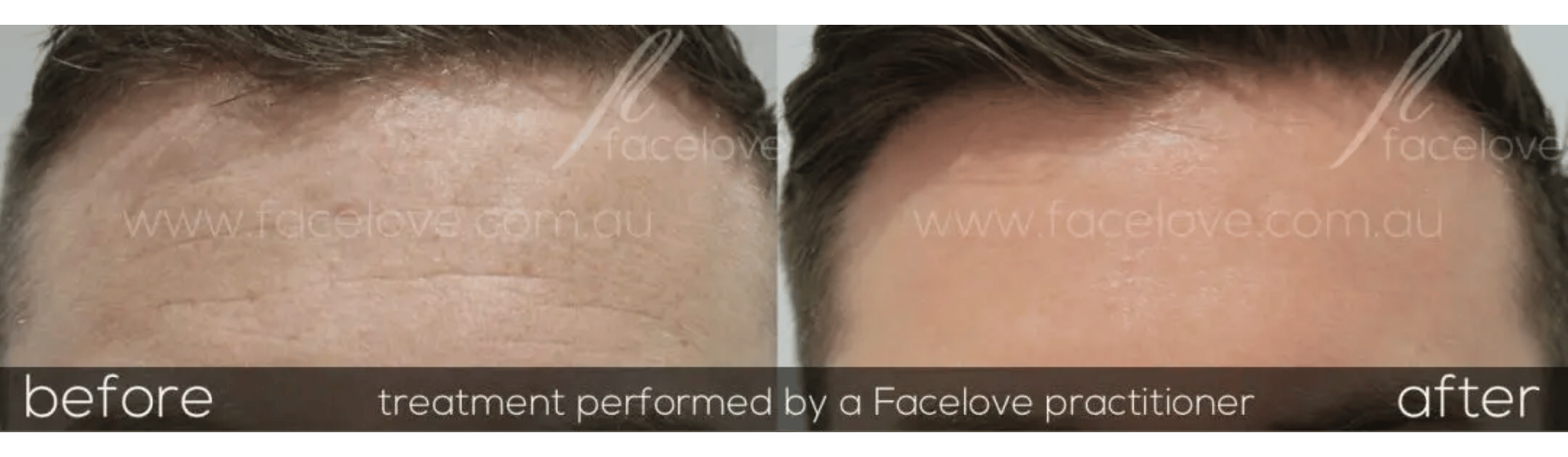 FaceLove patient result 8