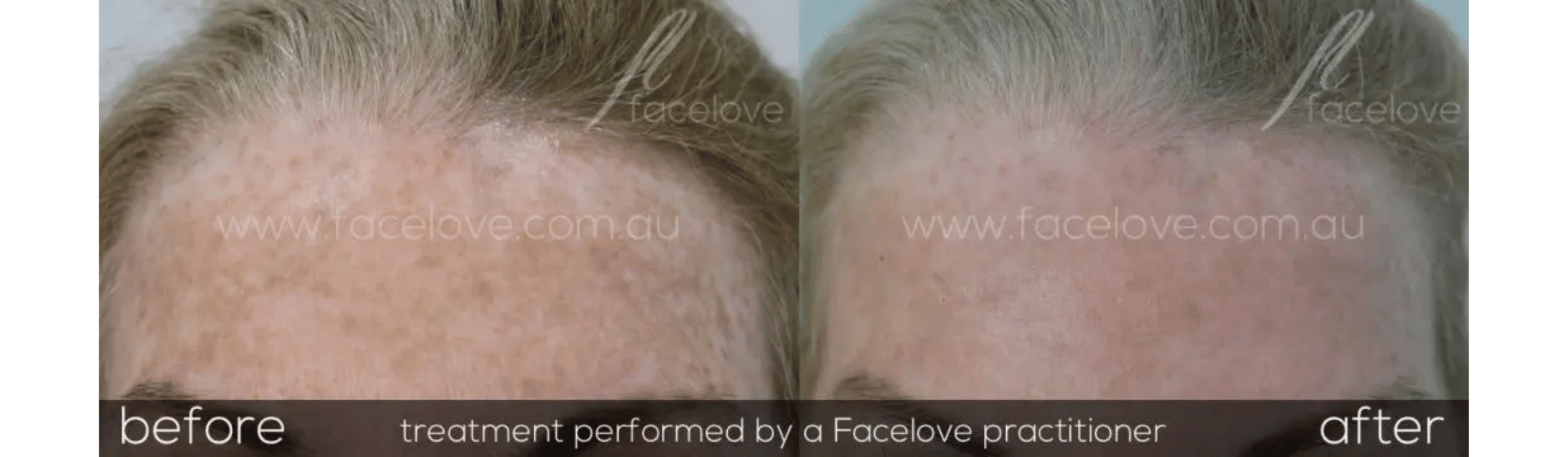 FaceLove patient result 9
