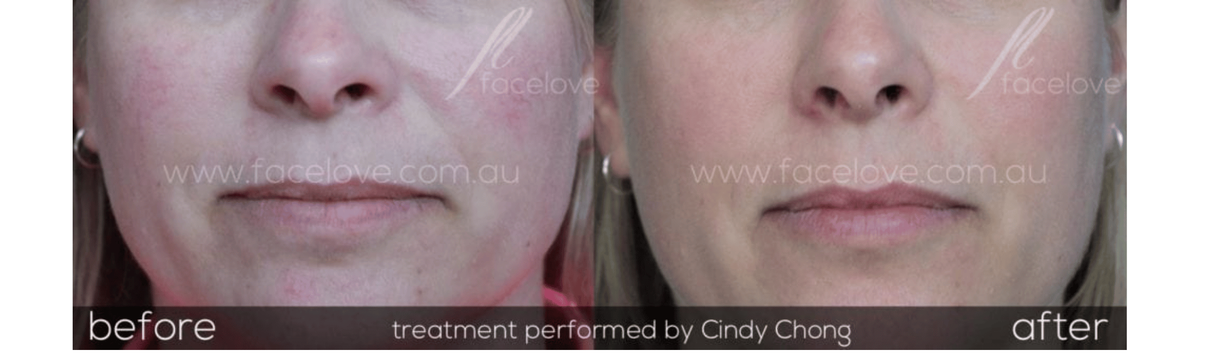 FaceLove patient result 7