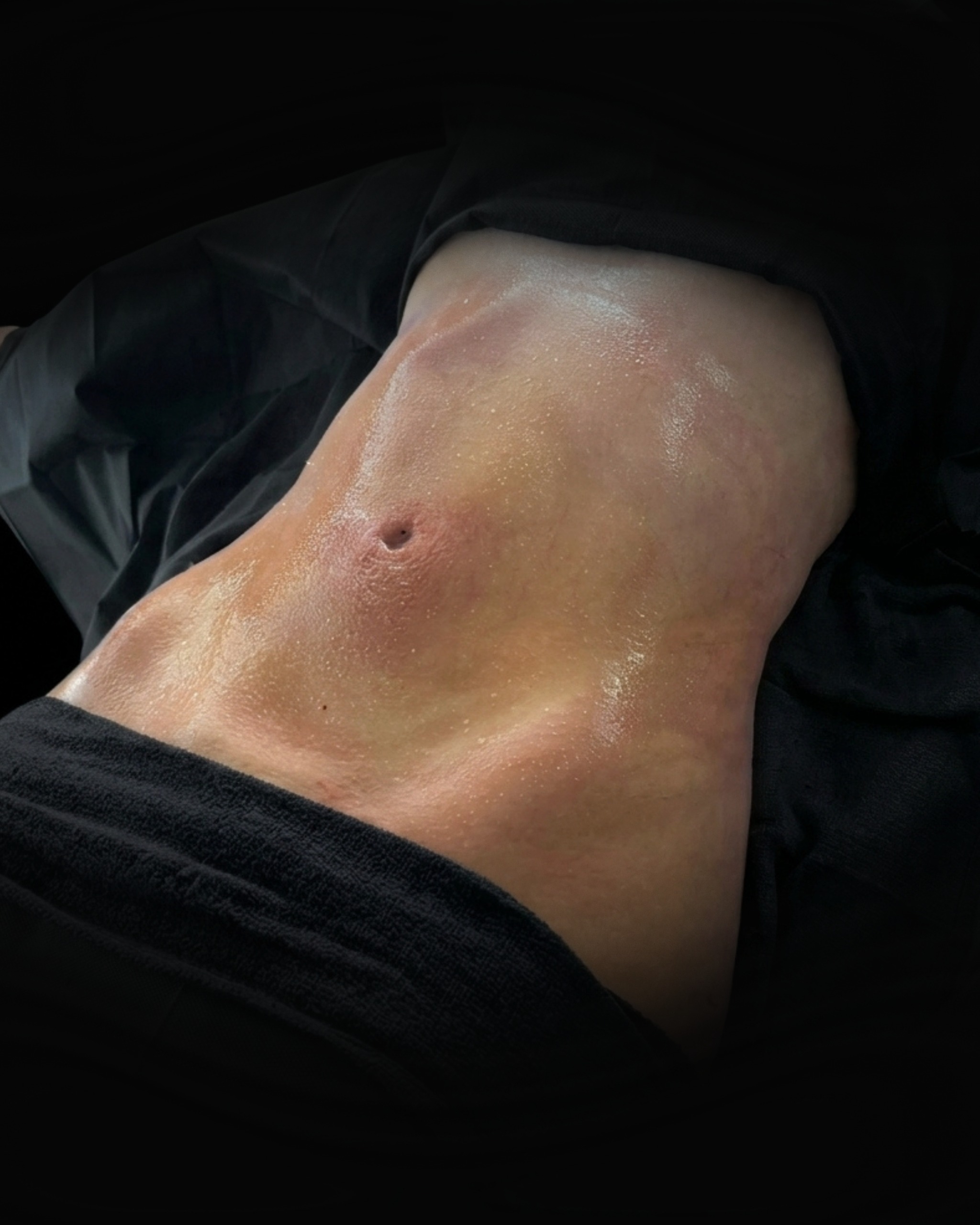 Lipo 360 - After