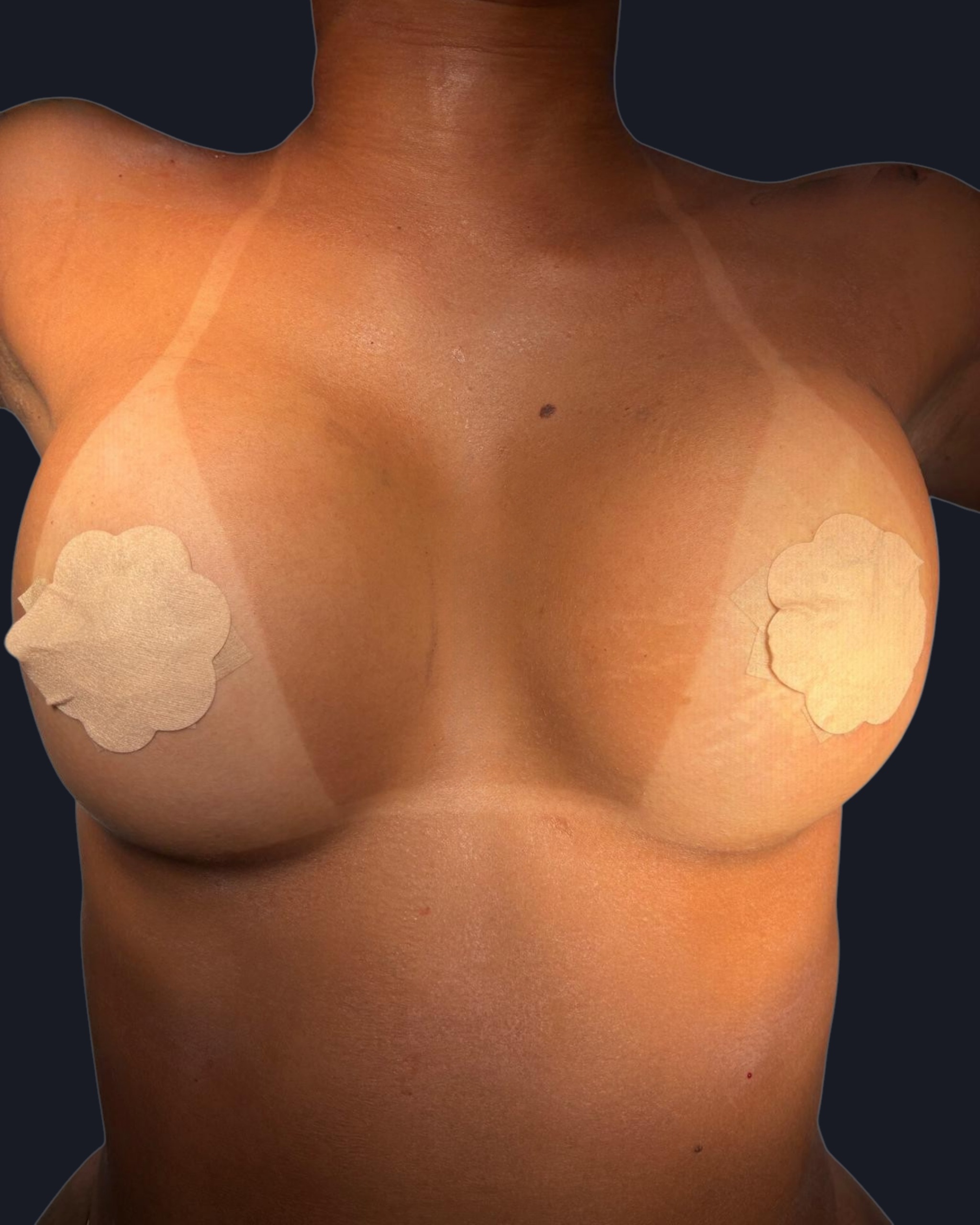 Breast Augmentation - After