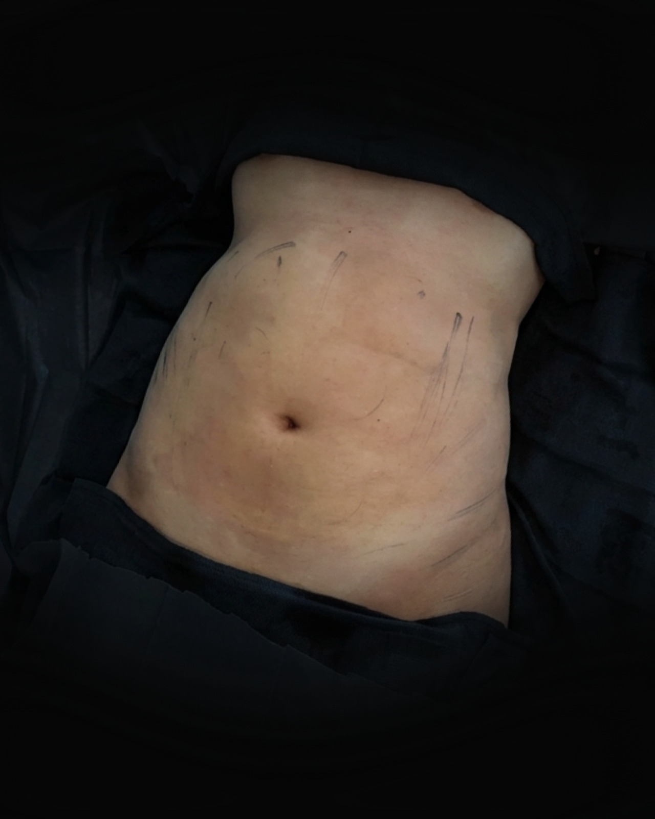 Lipo 360 - Before