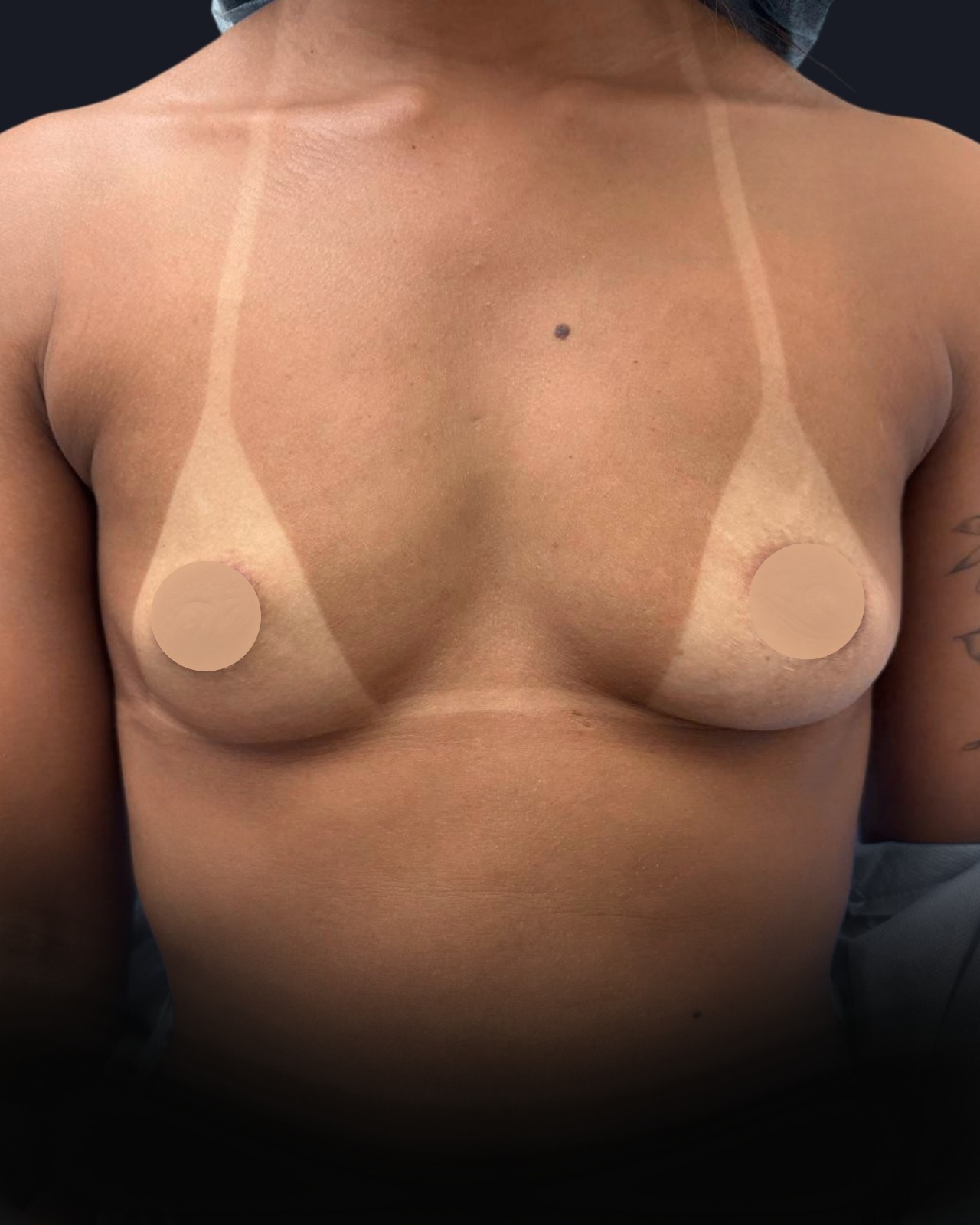 Breast Augmentation - Before