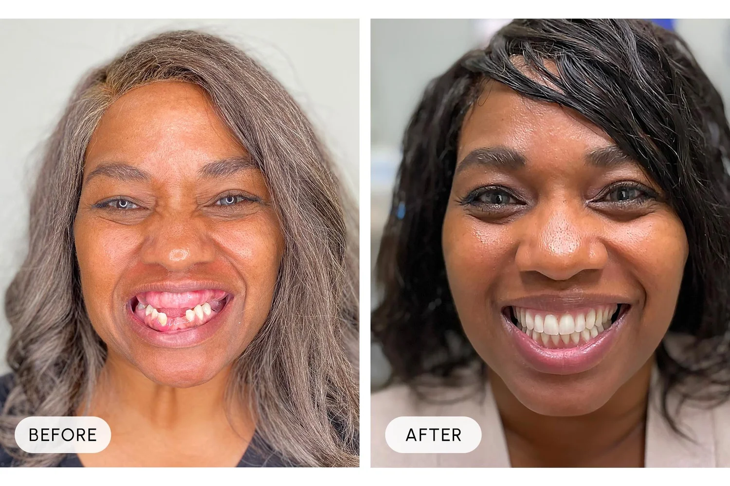 Bellaire Modern Dental before and after example 1