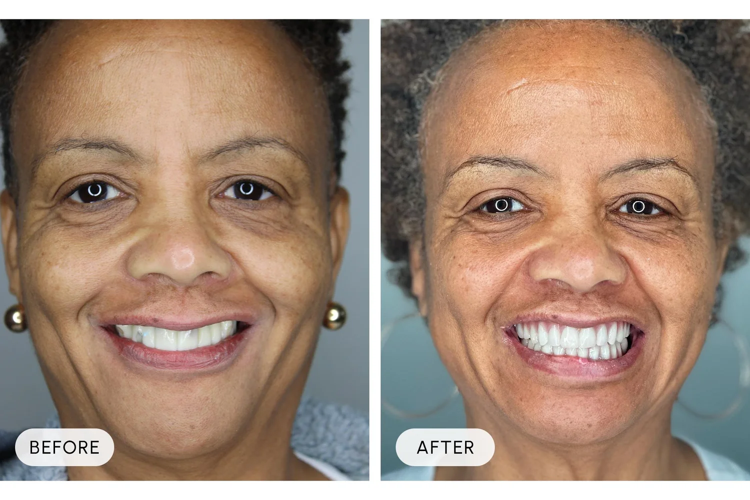 Bellaire Modern Dental before and after example 9