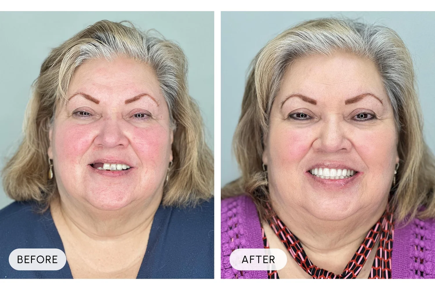 Bellaire Modern Dental before and after example 2