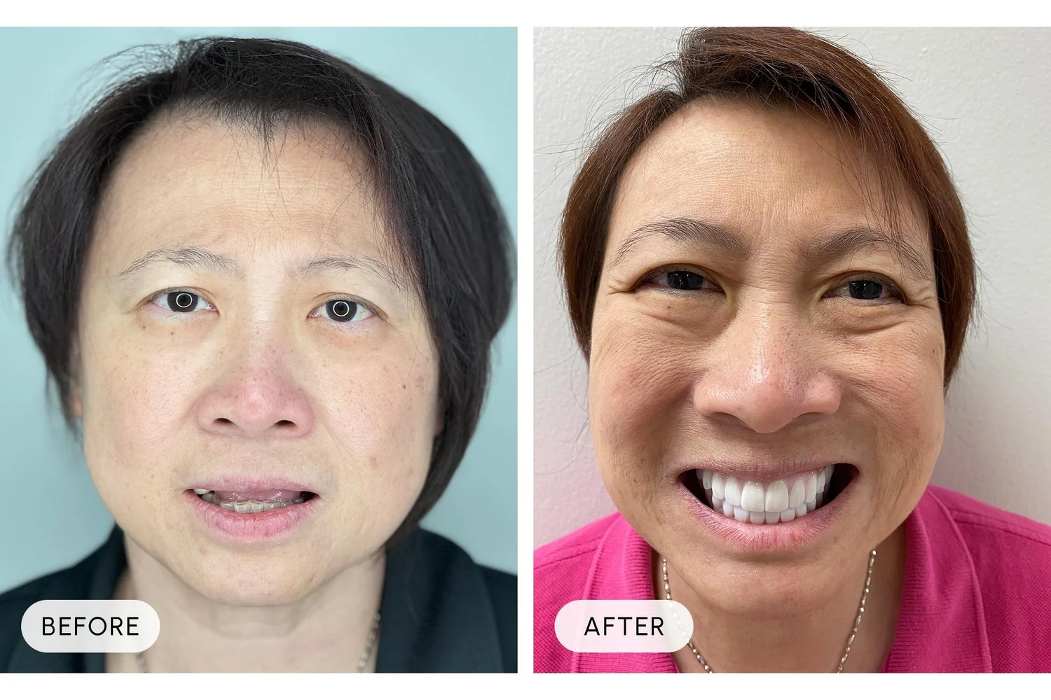 Bellaire Modern Dental before and after example 8