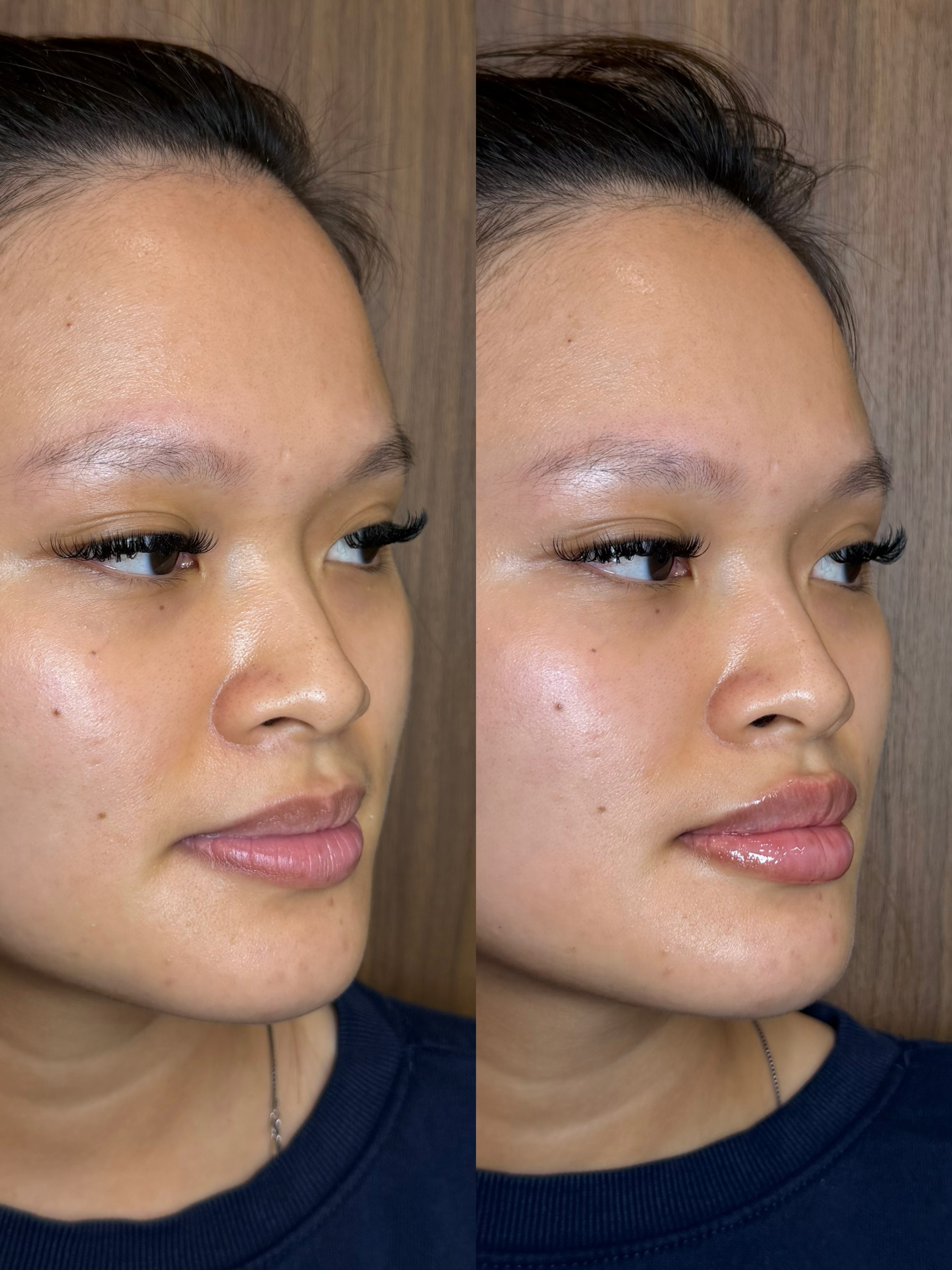Le Rosewood lip filler result, before left and after right