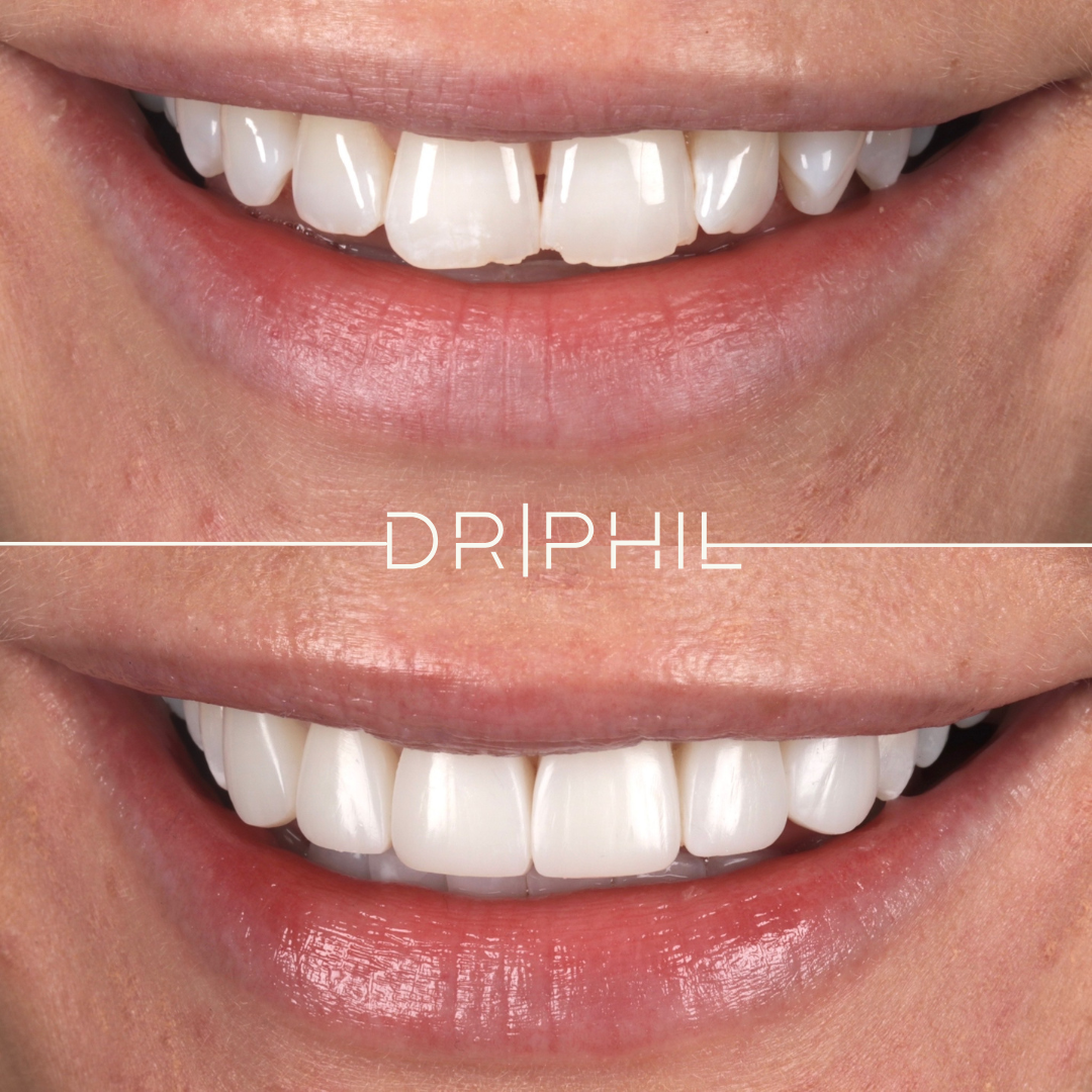Smile makeover before and after - Dr Phil Aesthetics