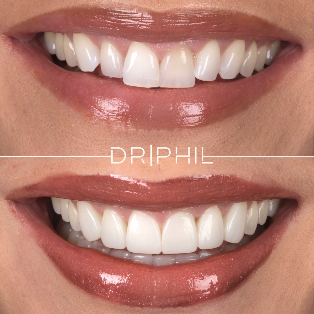 Composite bonding before and after - Dr Phil Aesthetics