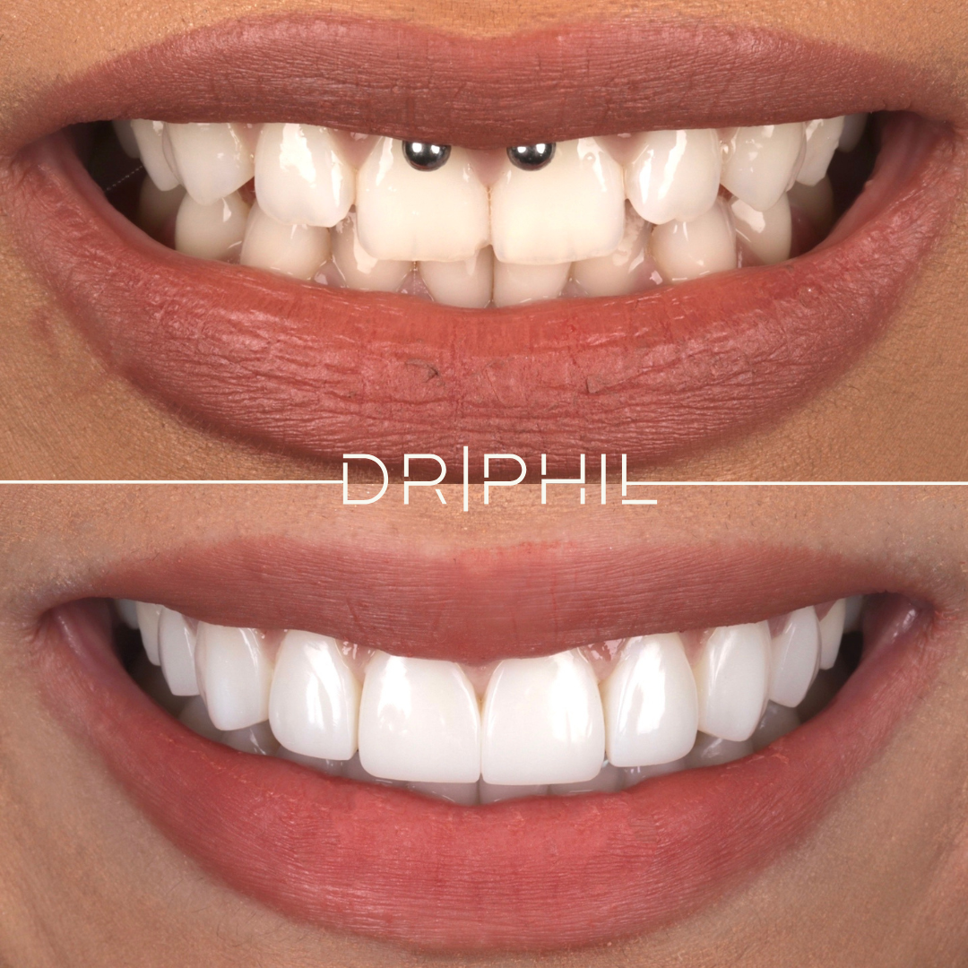 Teeth whitening and bonding result - Dr Phil Aesthetics