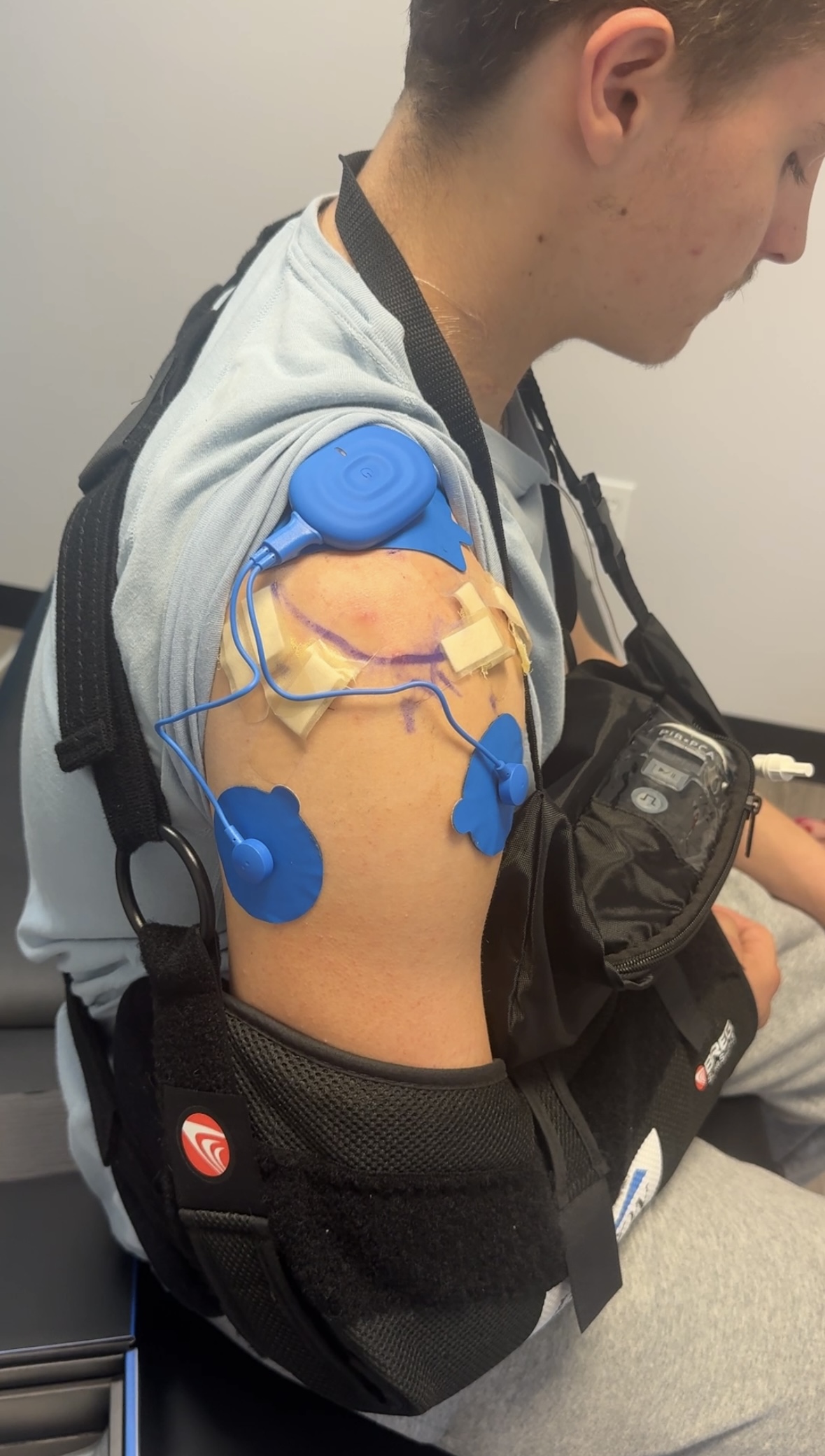 Shoulder Image after a rotator cuff surgery 