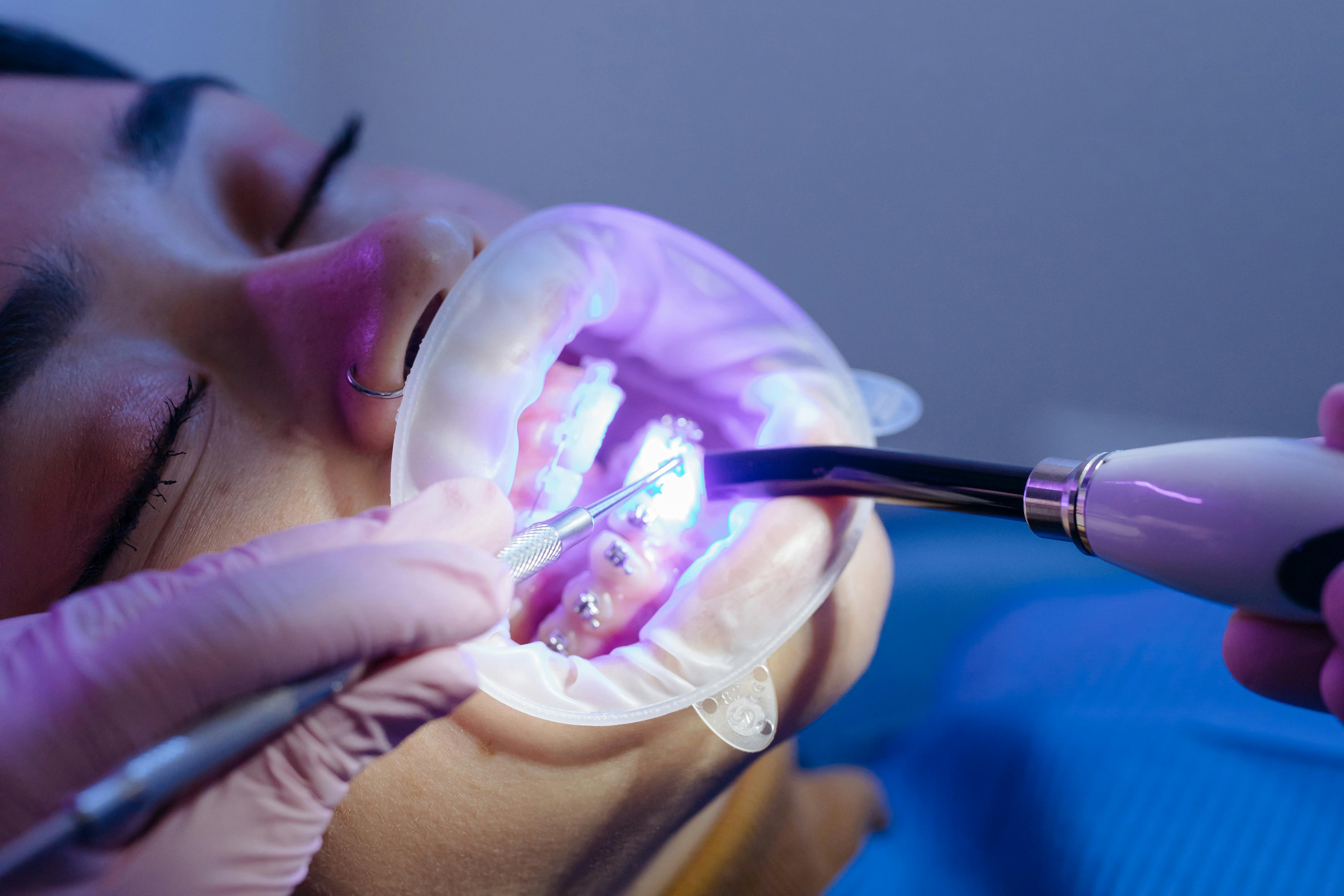 Invisalign clear aligners and braces treatment at Impact Dental Liverpool
