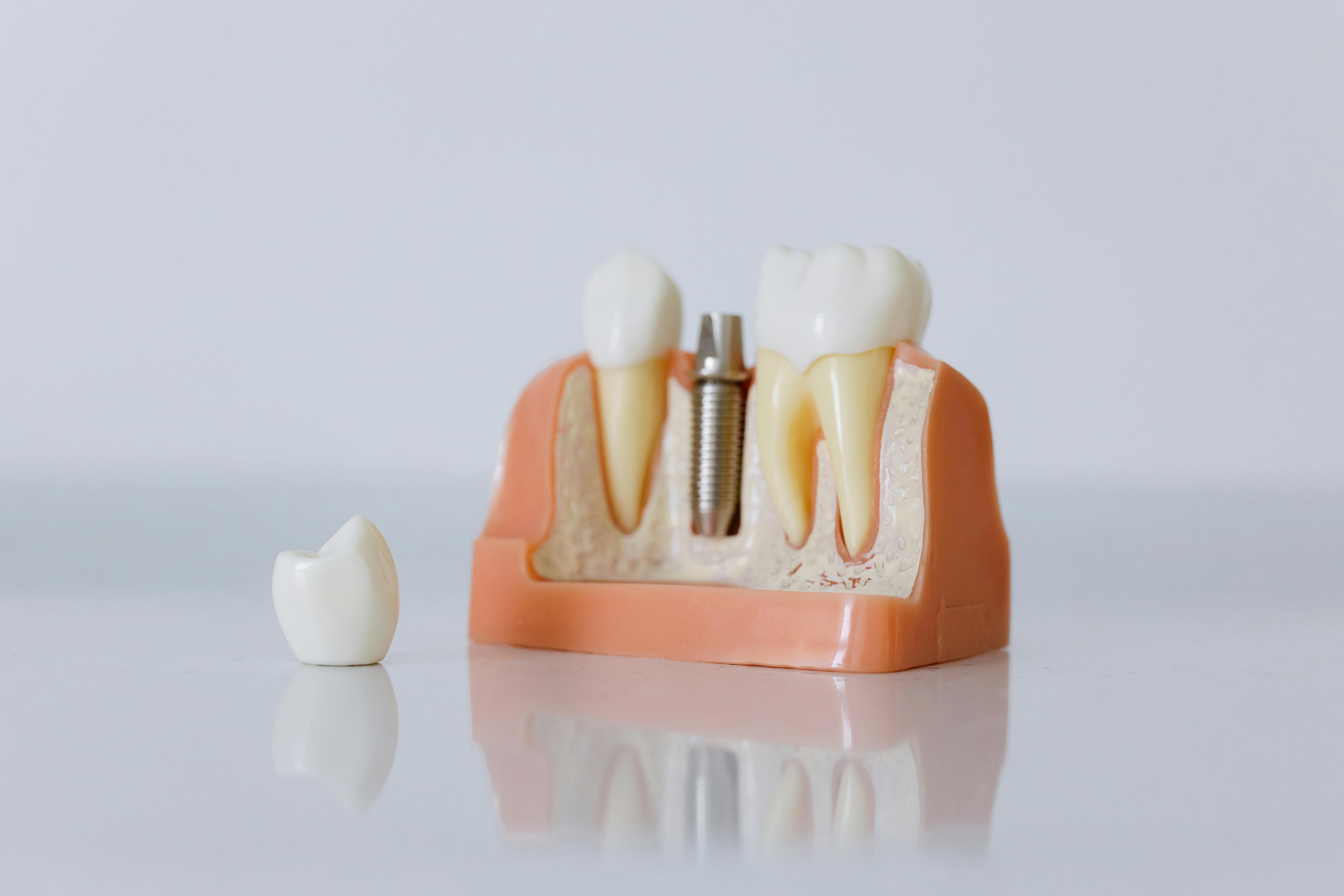 Dental crowns and bridges treatment at Impact Dental Liverpool