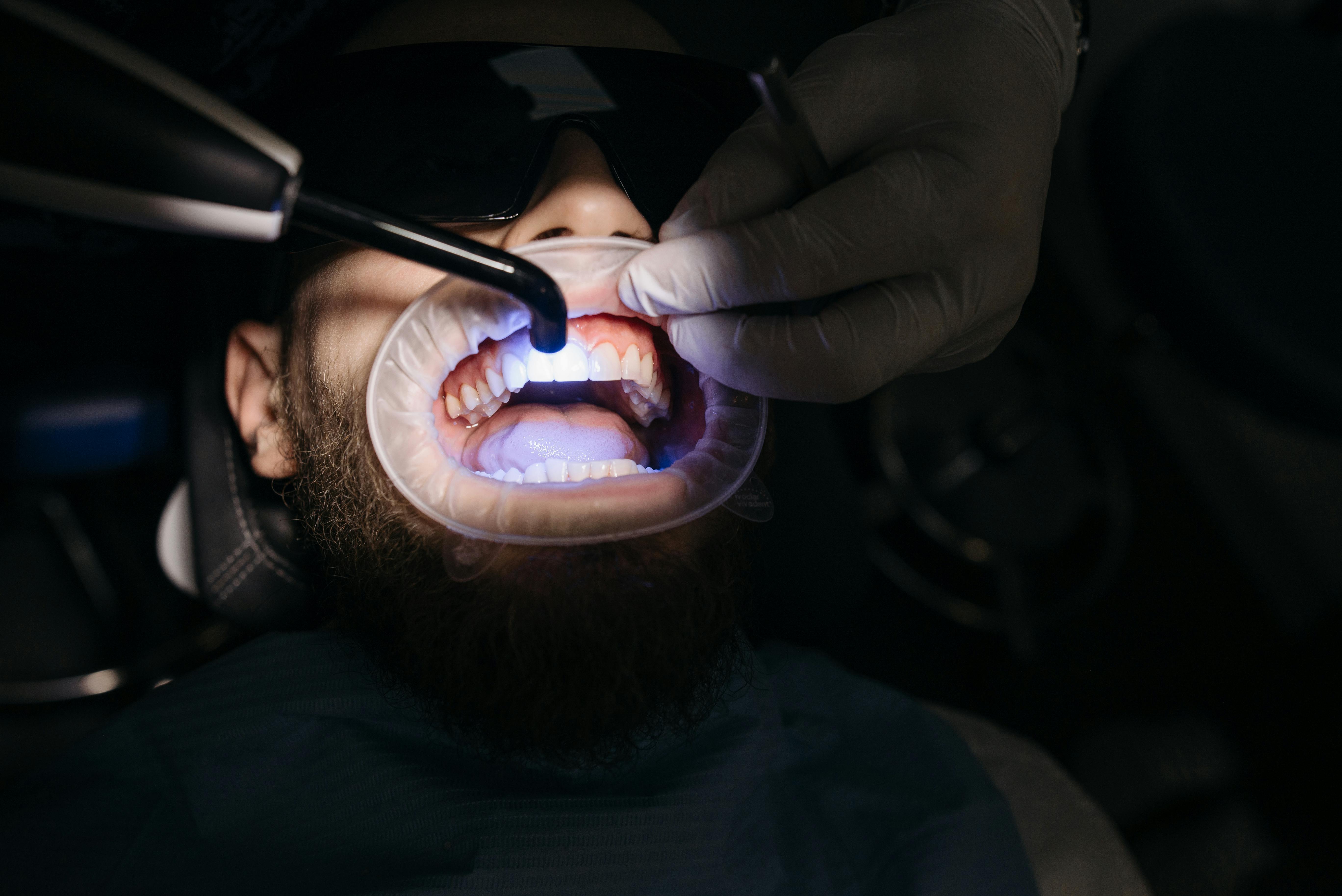 Composite bonding treatment at Impact Dental Liverpool