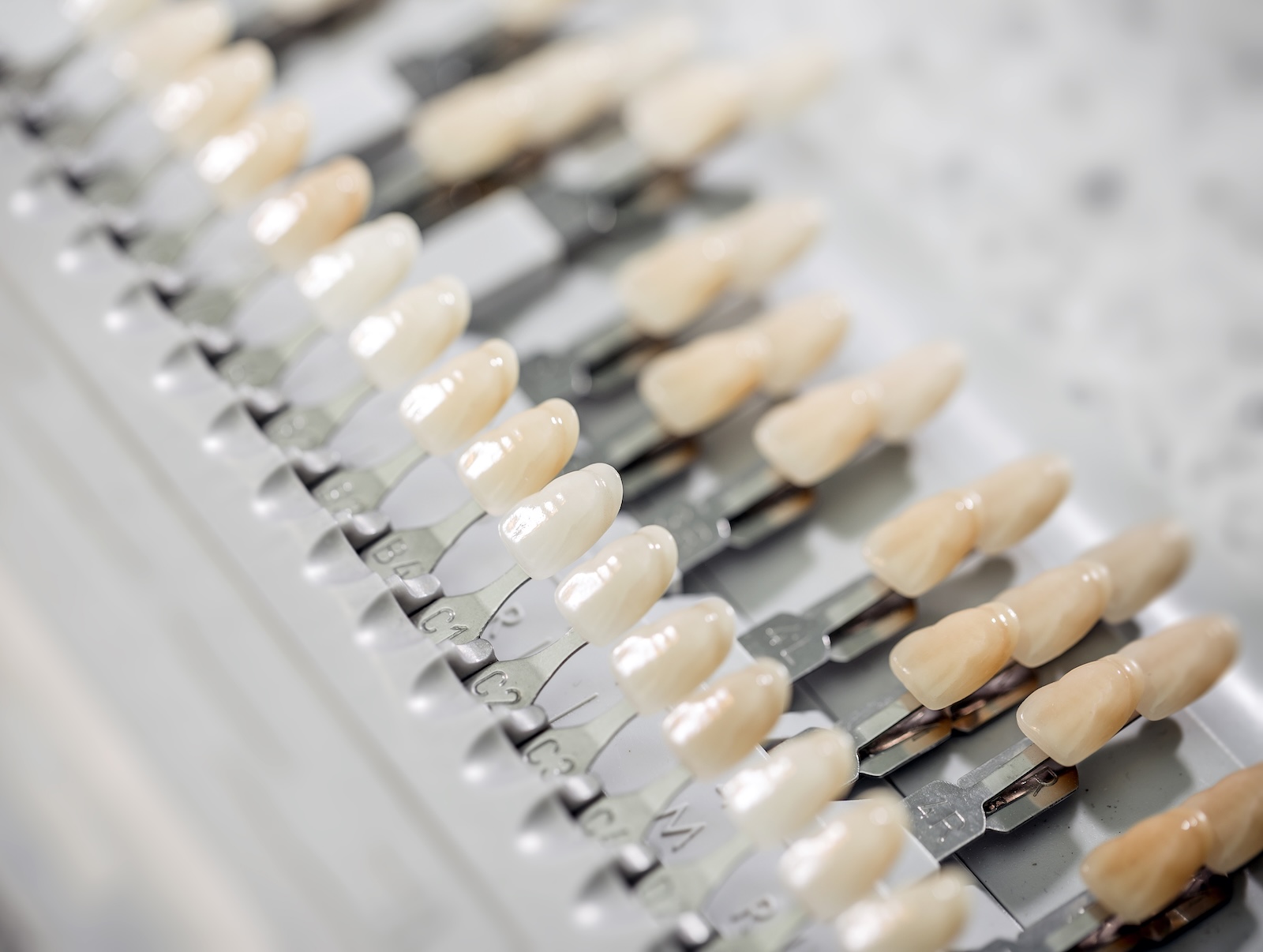Composite dental veneers at Impact Dental Liverpool