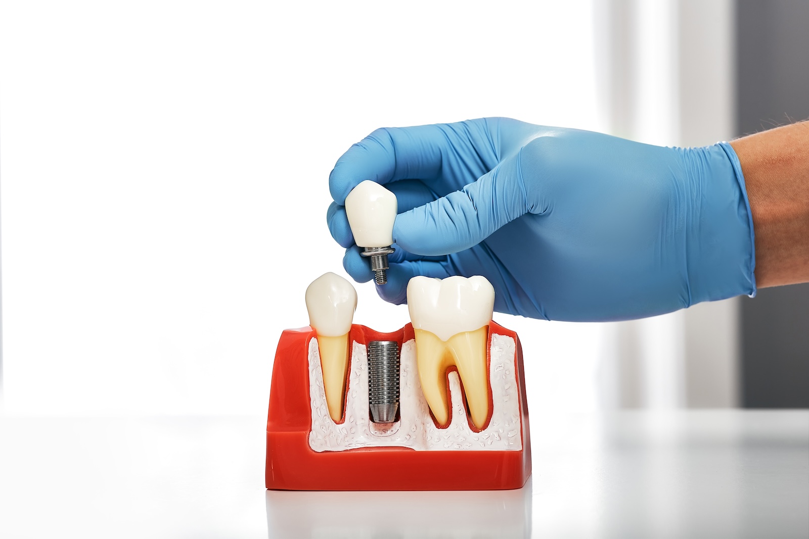 Close-up of a dental implant at Impact Dental Liverpool
