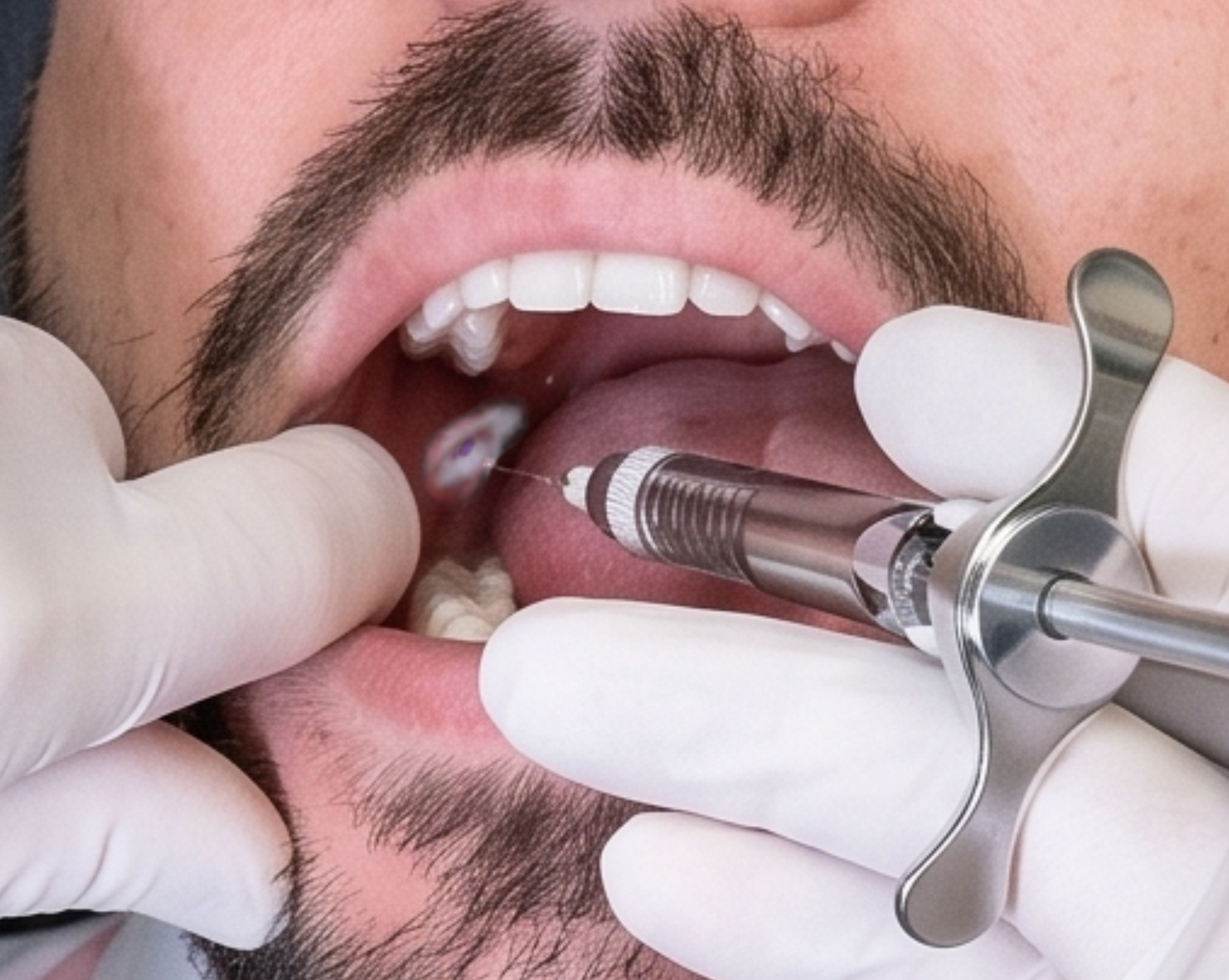 Inject immediately after spray