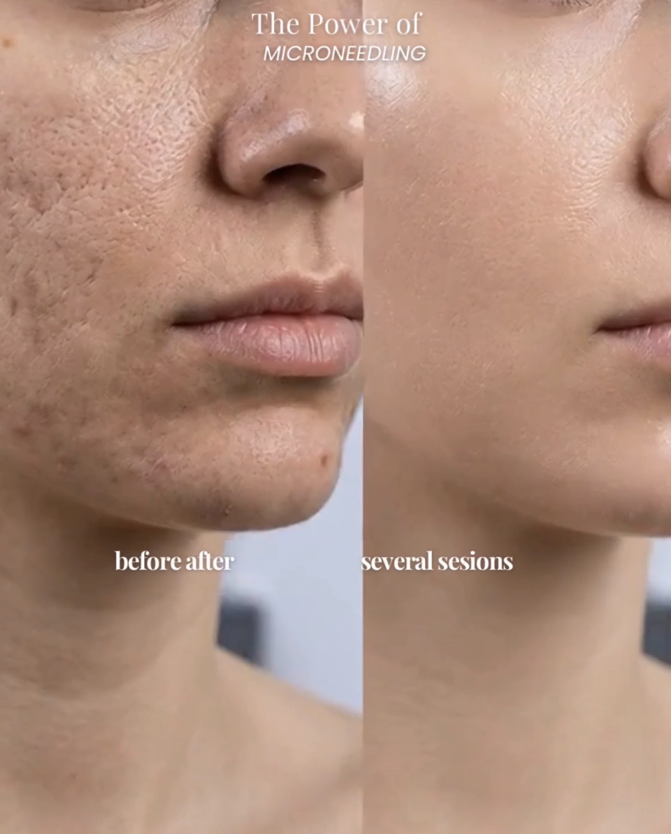 Skin rejuvenation Beauty Ink