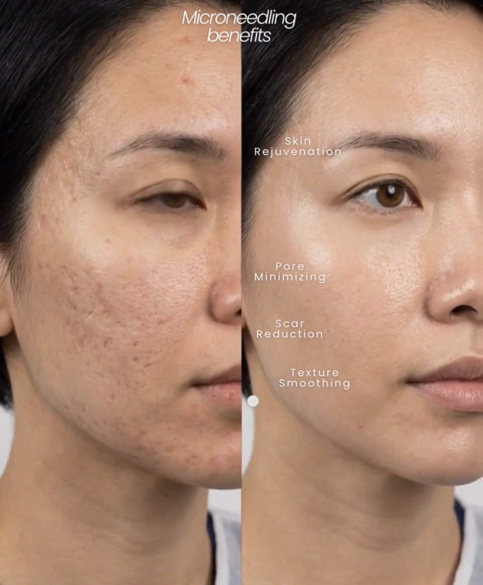 Refined skin texture and tone result
