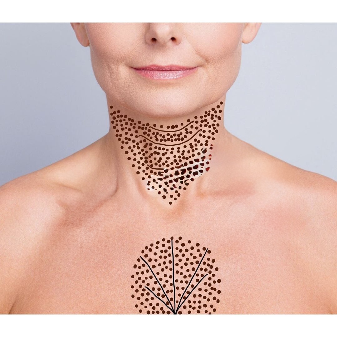 Neck Rejuvenation