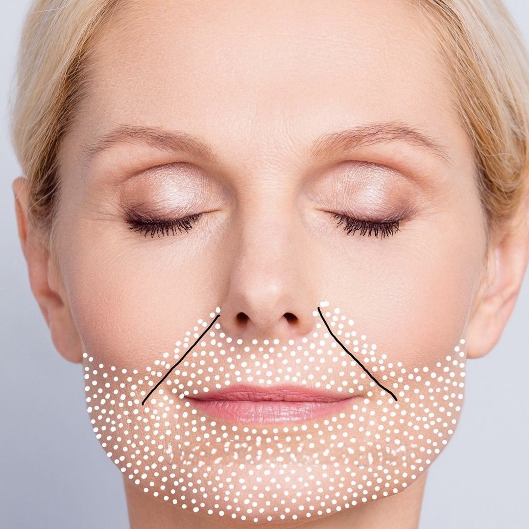 Non-Invasive Facelift Mini Face Lift