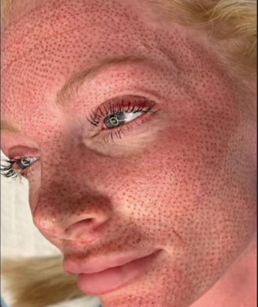 TSL Non-Invasive Facelift Full Face