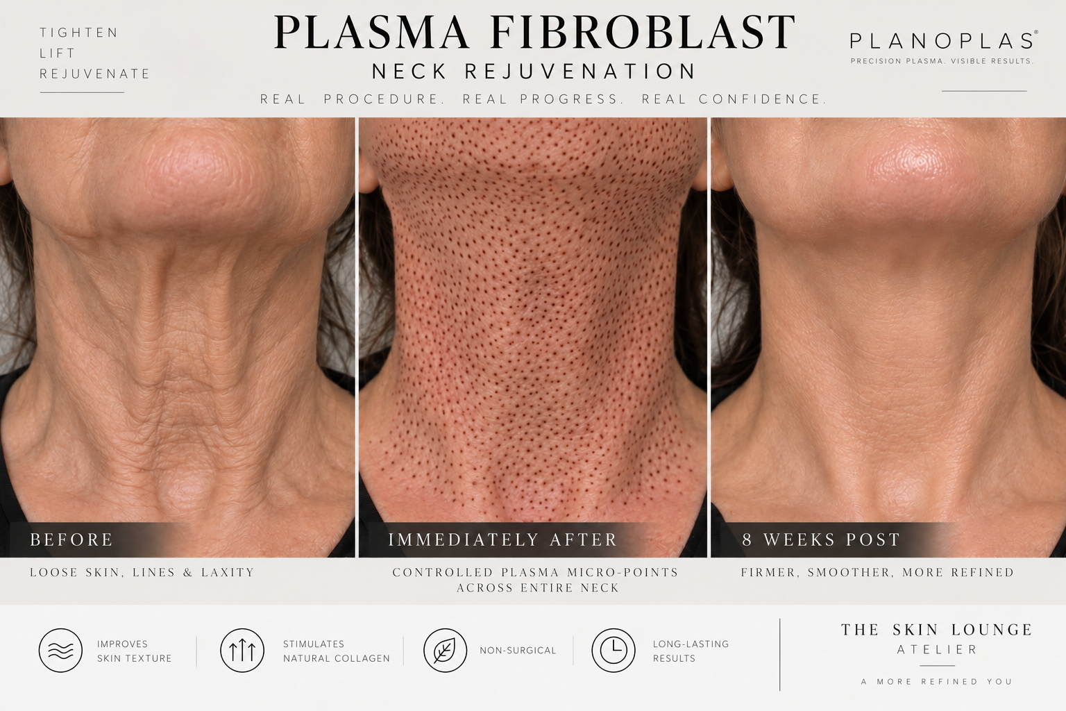 TSL Full Neck Rejuvenation, plasma skin tightening for the neck and décolletage in Fort Collins