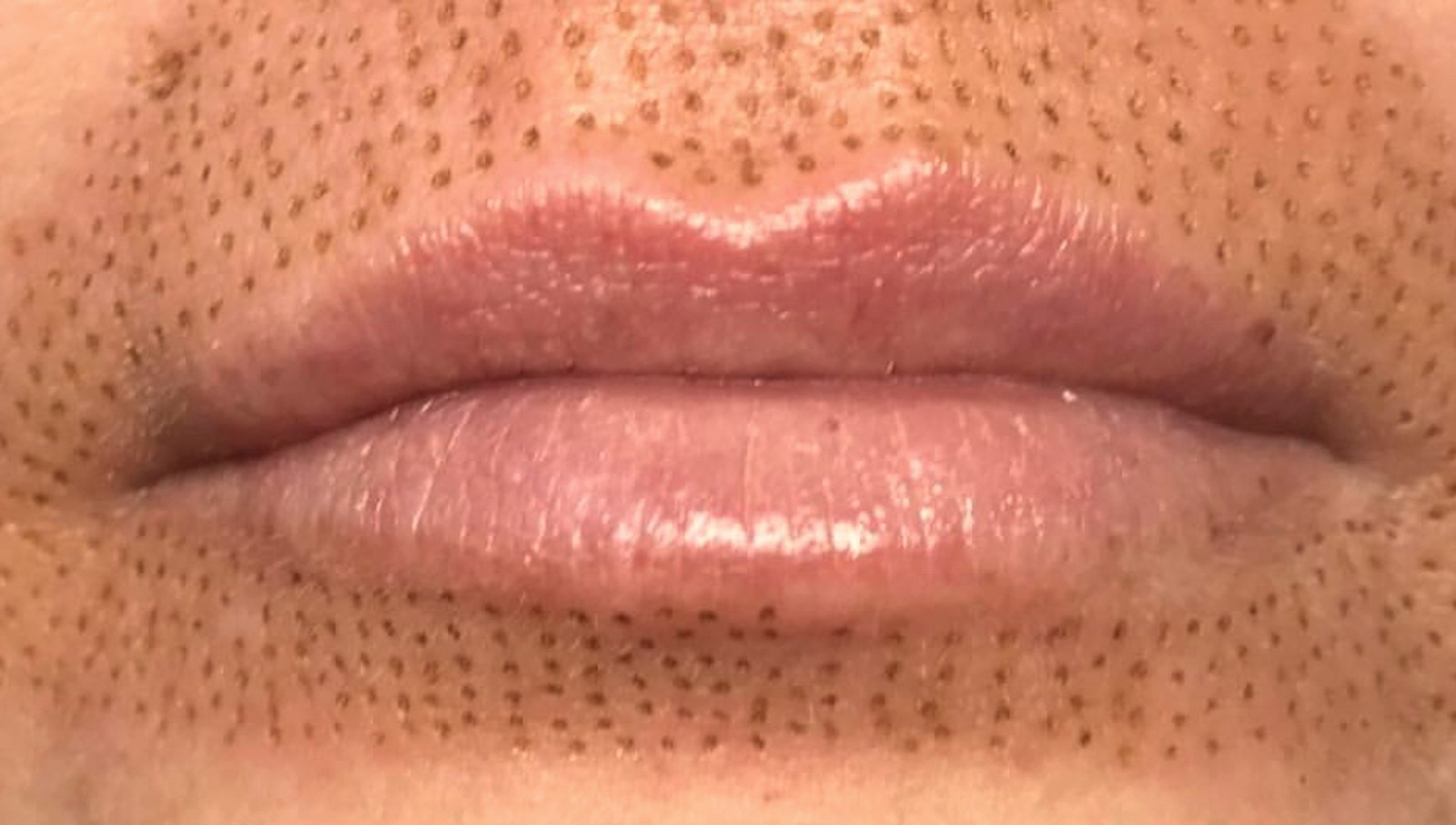 TSL Pout Perfector, plasma treatment for lip lines and lip definition in Fort Collins