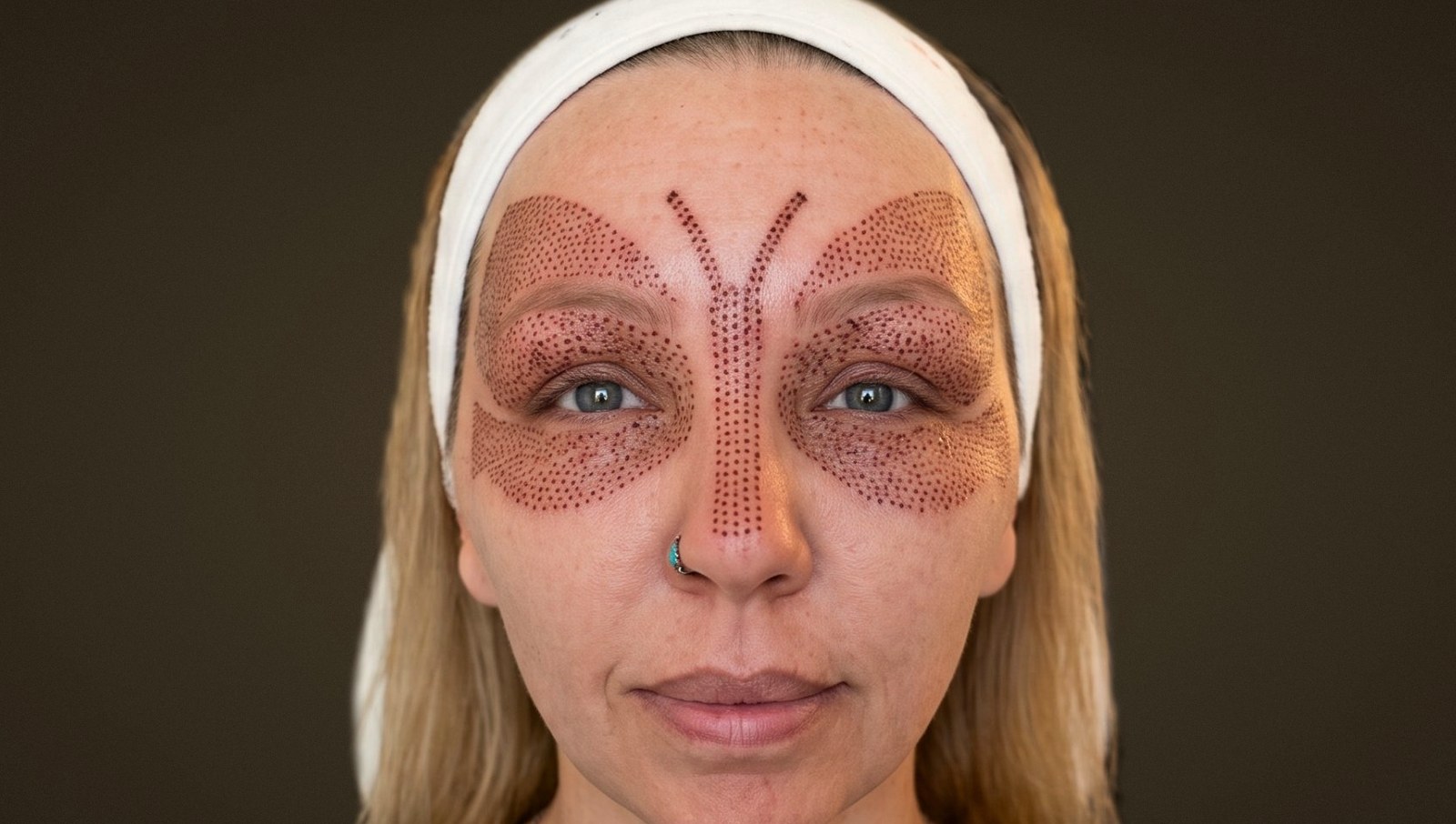 TSL Butterfly Lift, non-surgical plasma eyelid lift for hooded eyes in Fort Collins