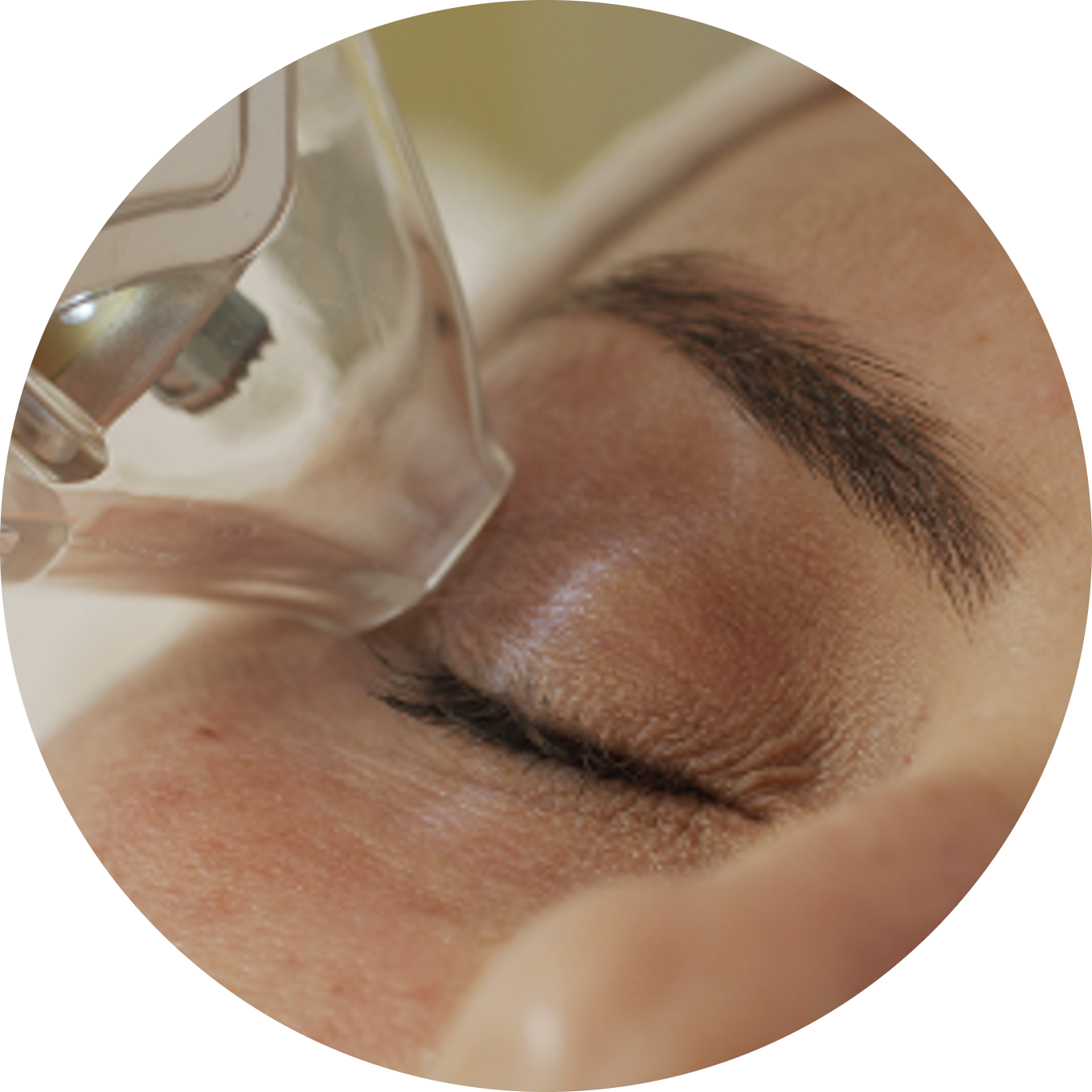 Dry Eye Relief With Tixel I Dry Eye Relief With Tixel I