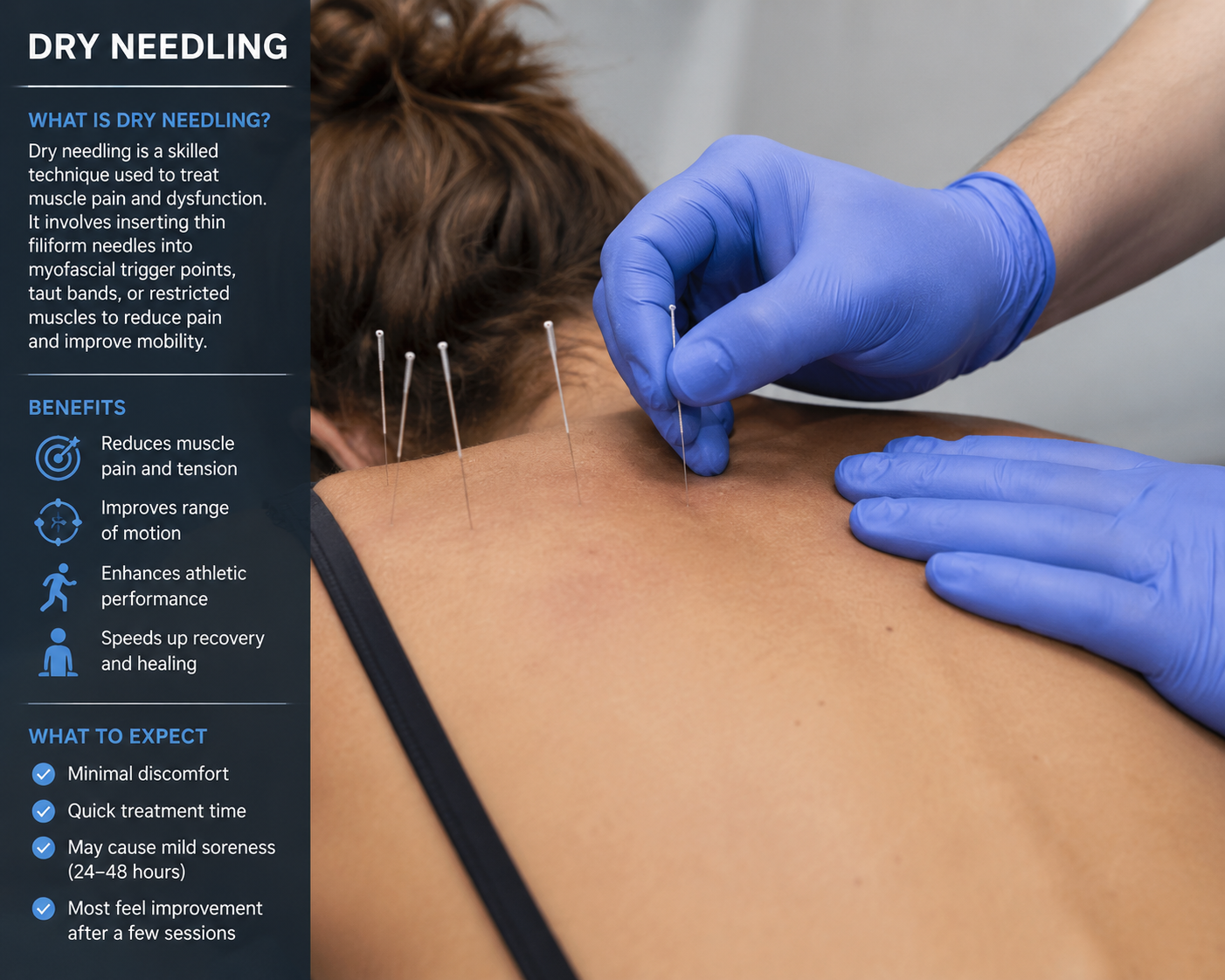 Dry Needling Therapy on Back