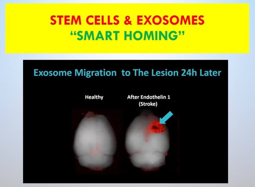 Exosome smart homing to stroke lesion — brain scan