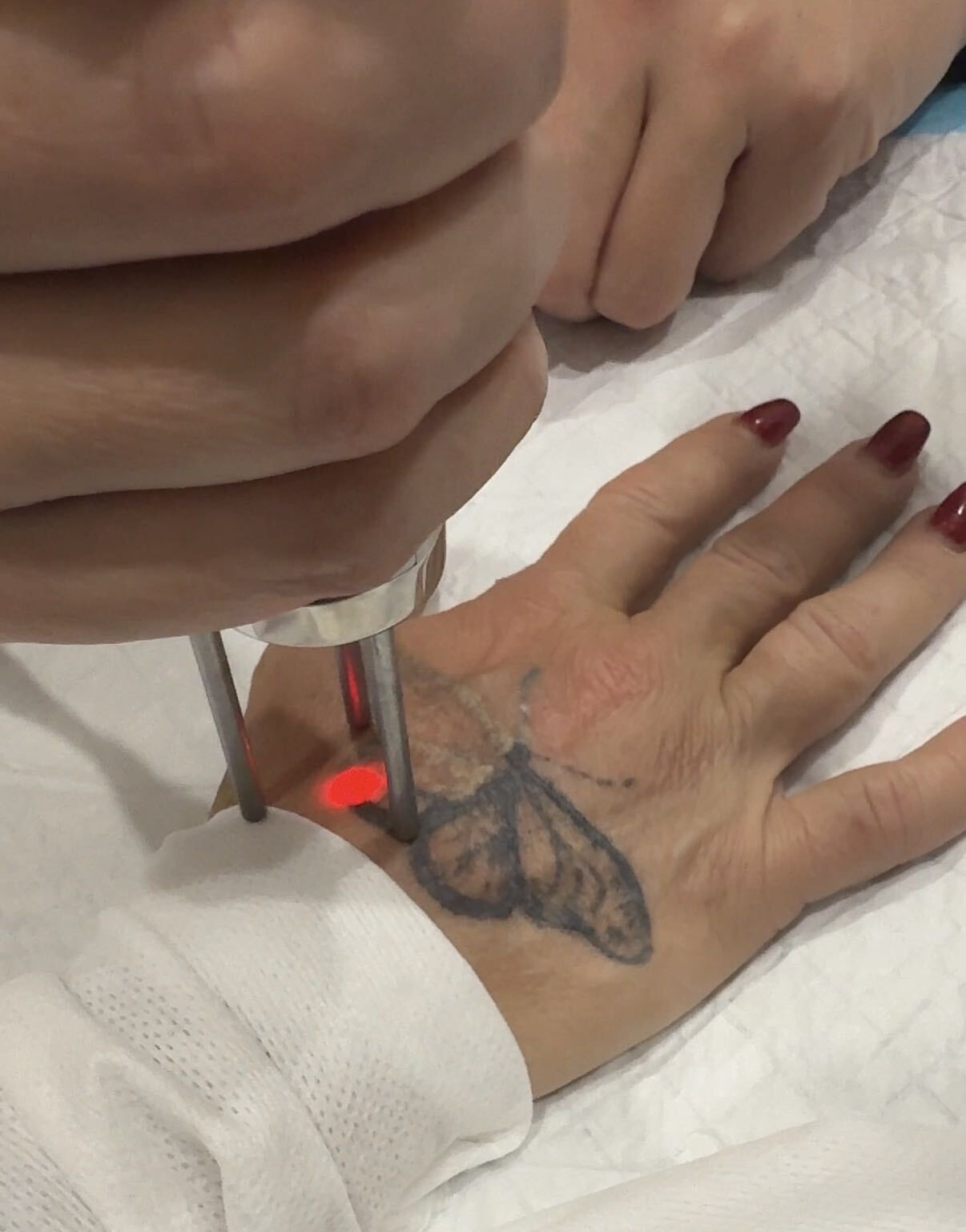 Pico laser tattoo removal