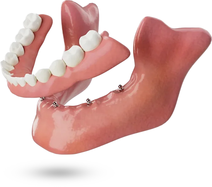 Lower denture stabilized with MiniCare mini implants