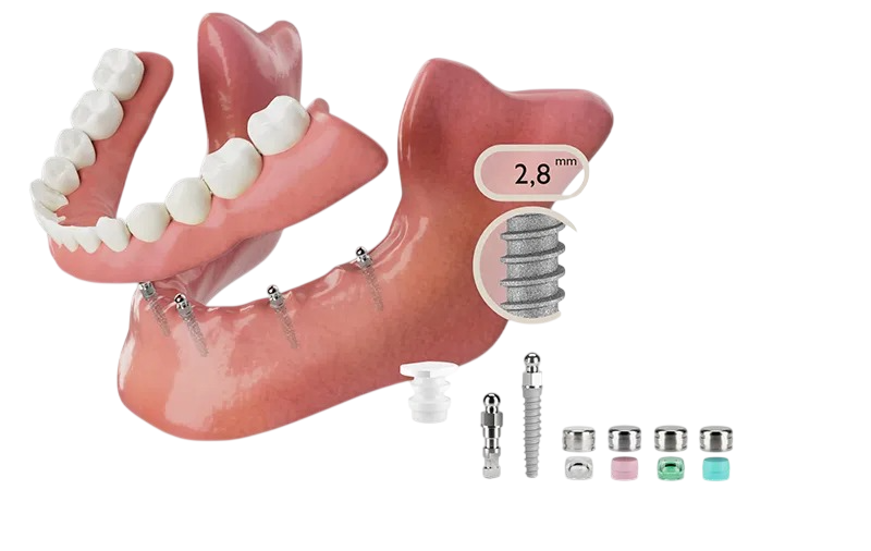 MiniCare mini dental implants