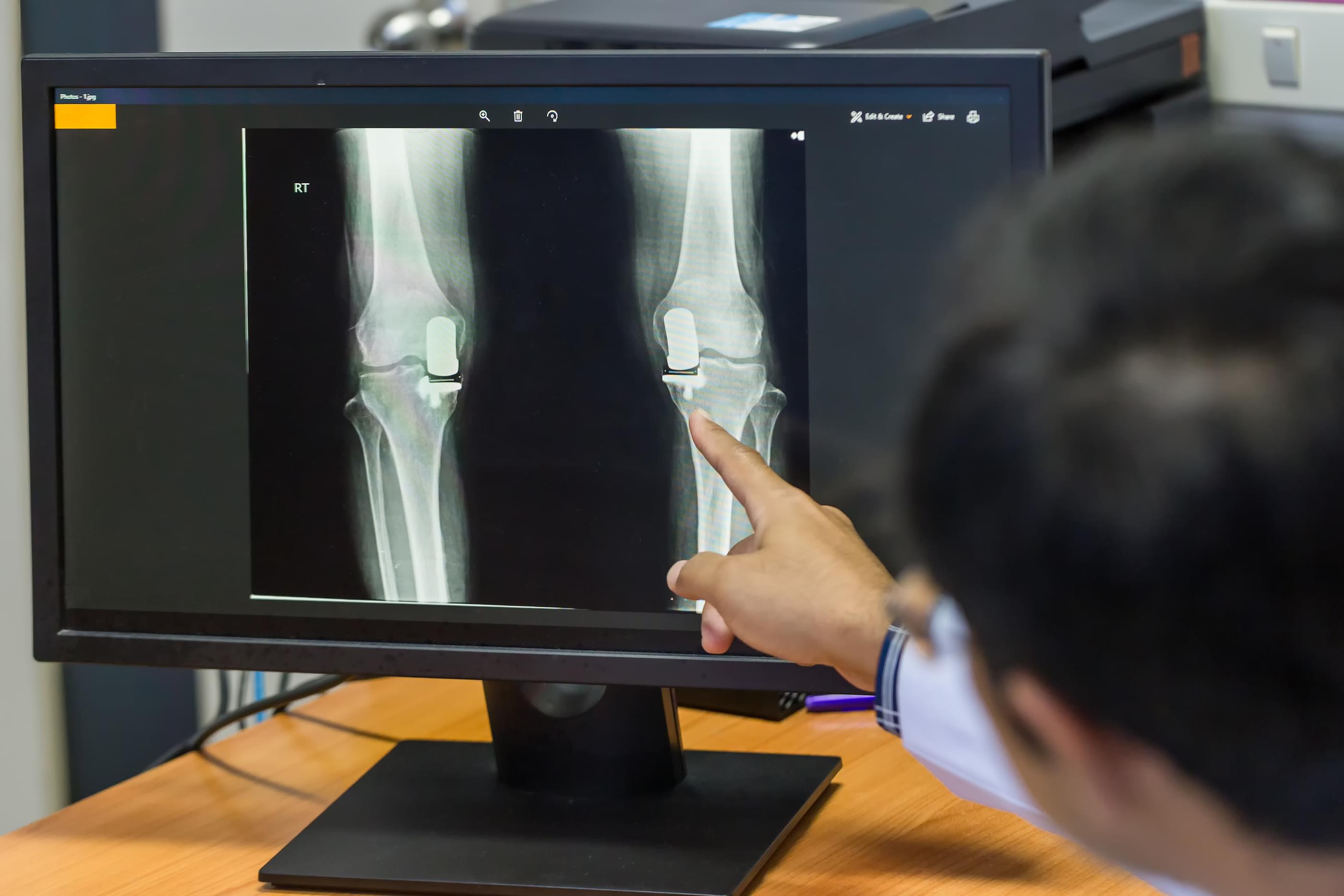 A Knee 'Replacement' Without Surgery? It's Finally Here.