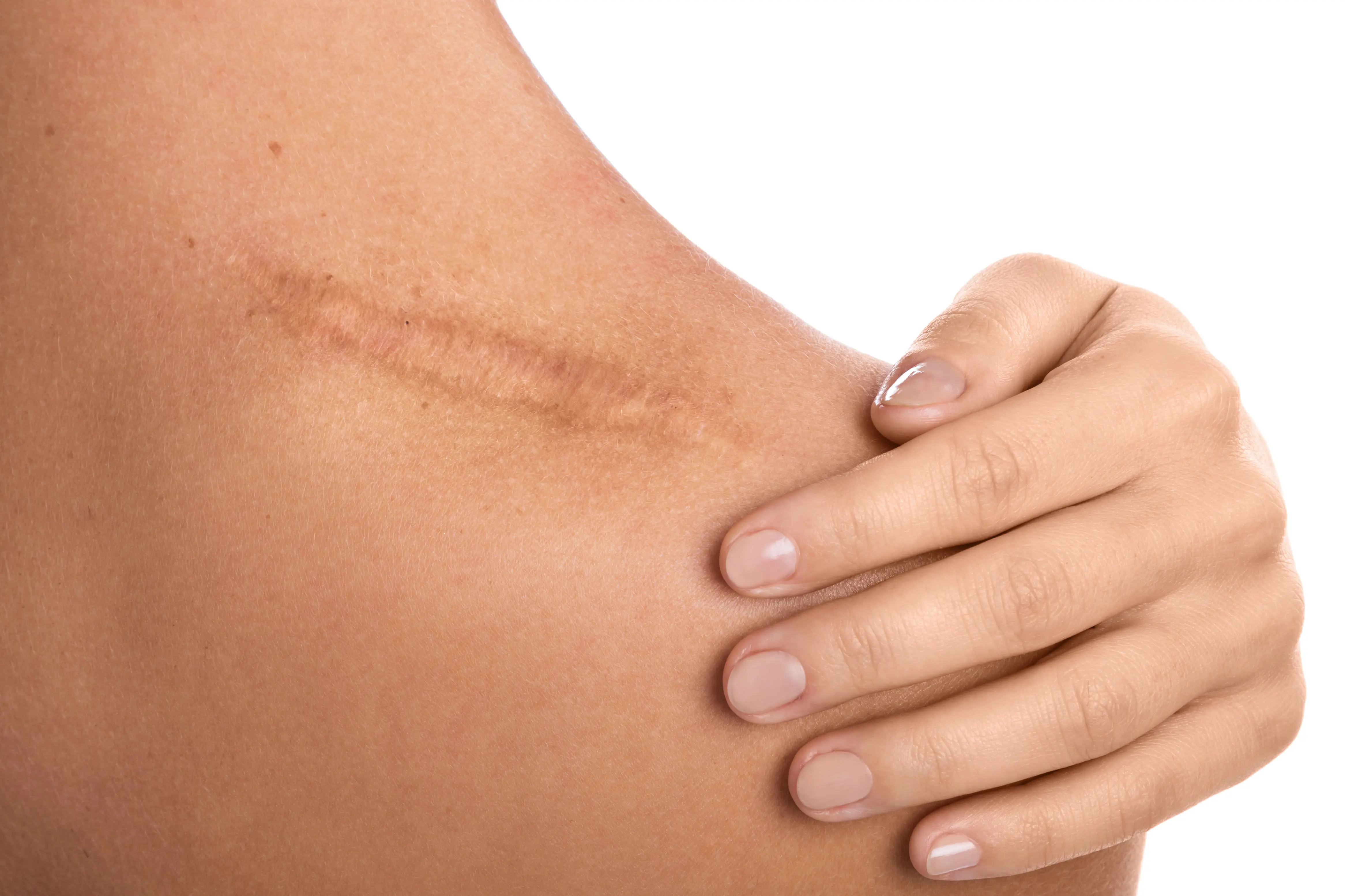 Bryght Skin Lightening Large Scar (Over 3 Inches)