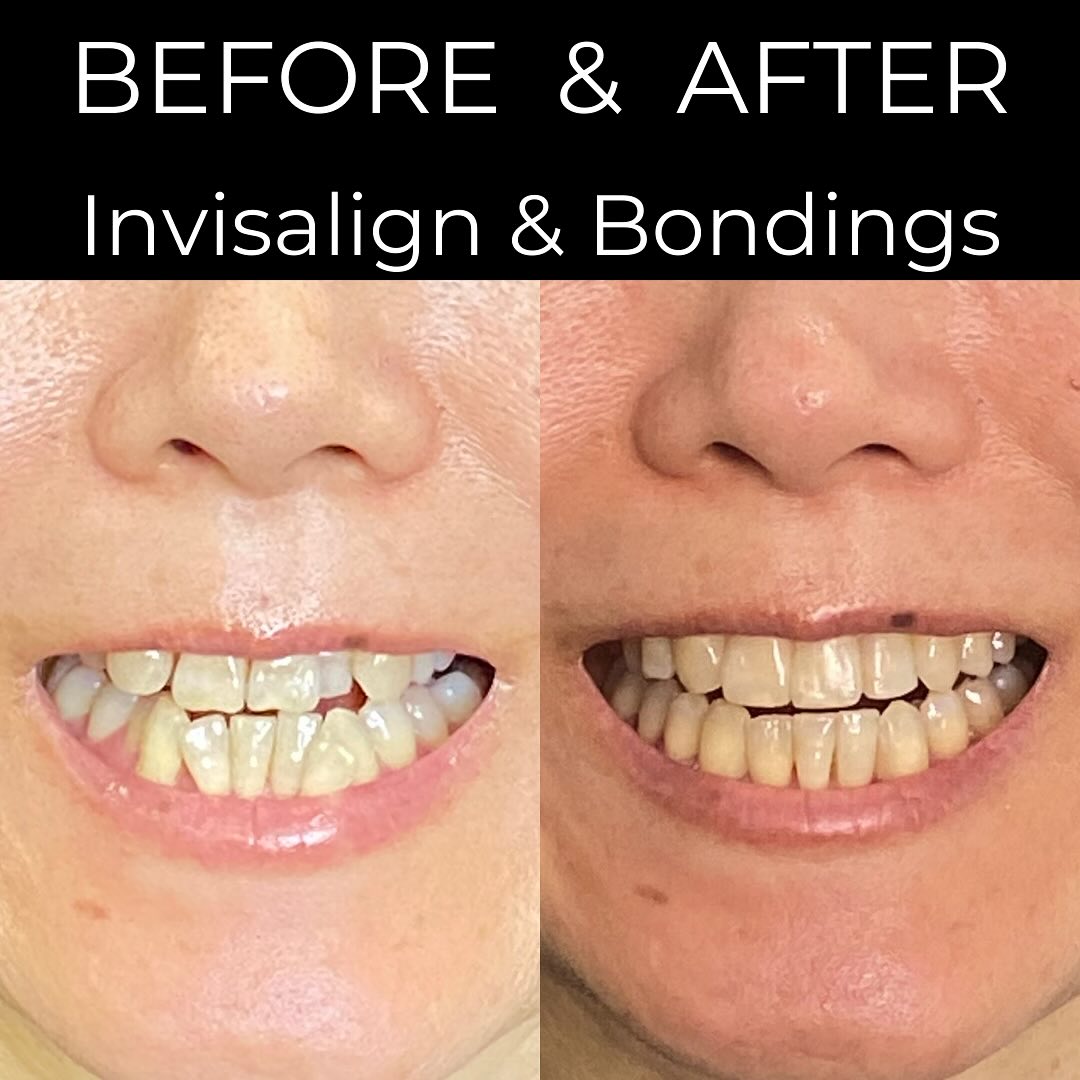 Invisalign before and after patient result at The Village Dentist Toronto