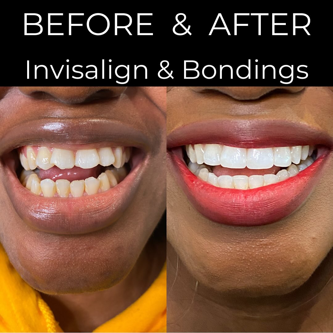Smile makeover before and after combining Invisalign and composite bonding at The Village Dentist Toronto