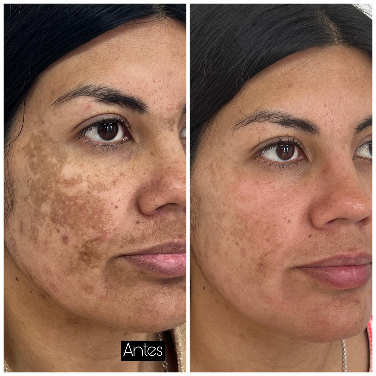Antes y después del tratamiento de melasma severo con peeling amarillo en Clínica Dermodent