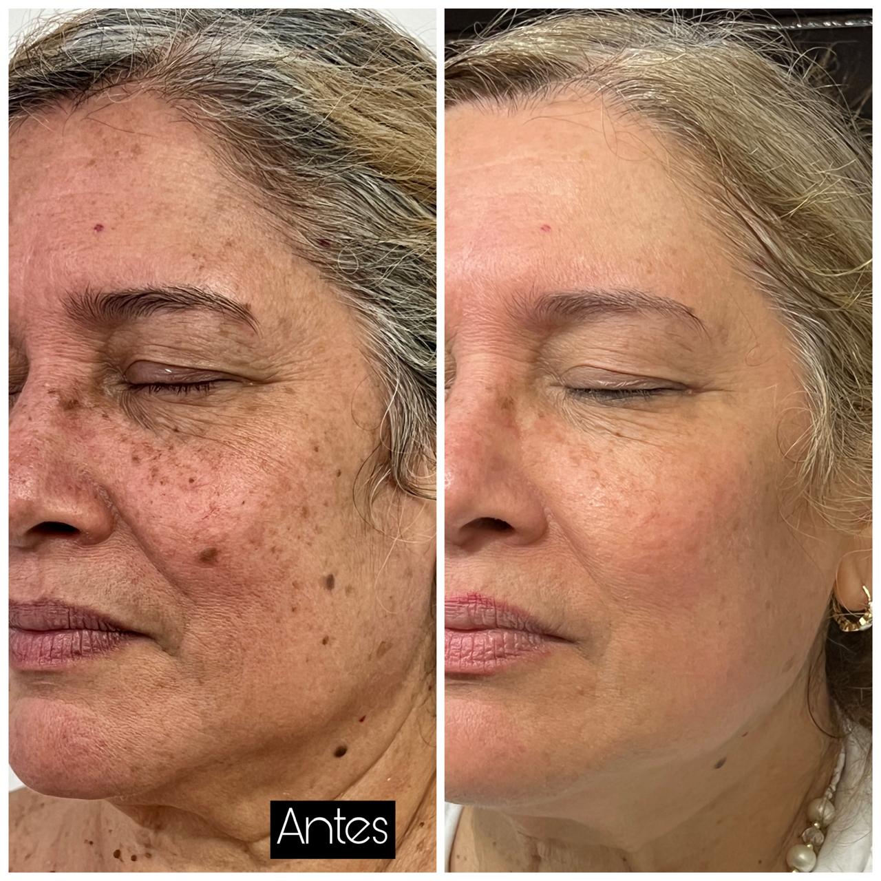 Antes y después del tratamiento láser para manchas en la cara por léntigo solar en Clínica Dermodent